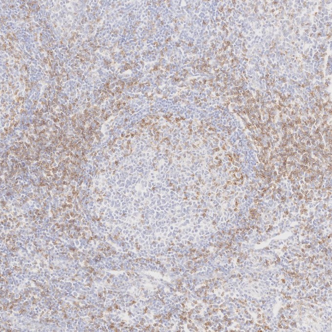 IHC staining of human tonsillitis using 65150-1-Ig IHC staining of human tonsillitis using 65150-1-Ig