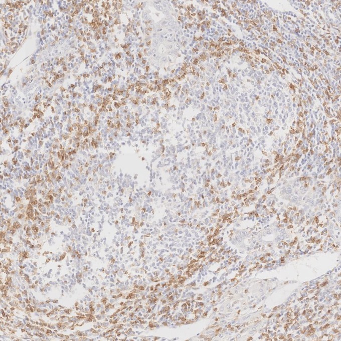 IHC staining of human lymphoma using 65150-1-Ig IHC staining of human lymphoma using 65150-1-Ig