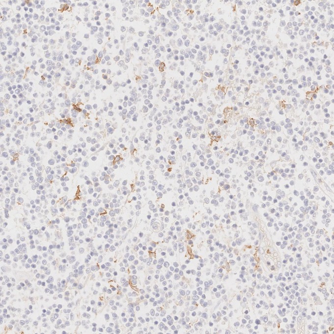 IHC staining of human lymphoma using 65150-1-Ig IHC staining of human lymphoma using 65150-1-Ig