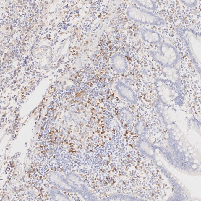 IHC staining of human lymphoma using 65150-1-Ig IHC staining of human lymphoma using 65150-1-Ig