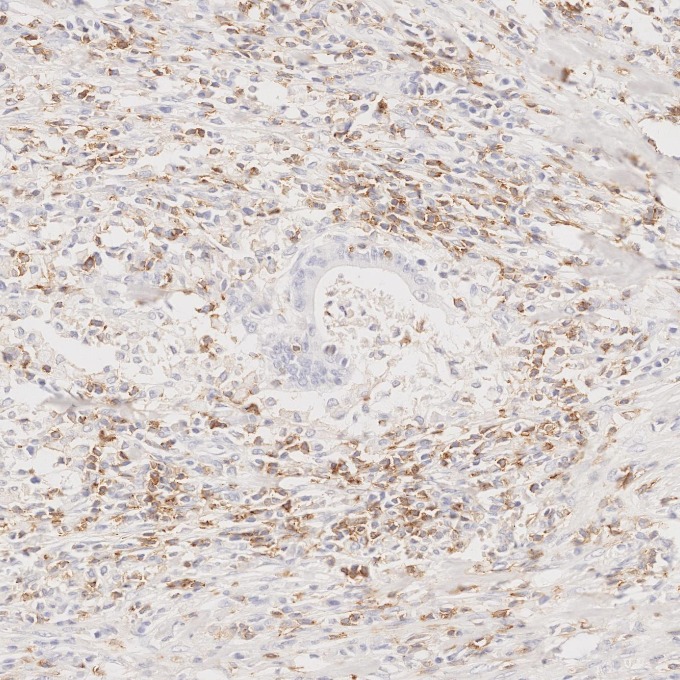 IHC staining of human colorectal cancer using 65150-1-Ig IHC staining of human colorectal cancer using 65150-1-Ig