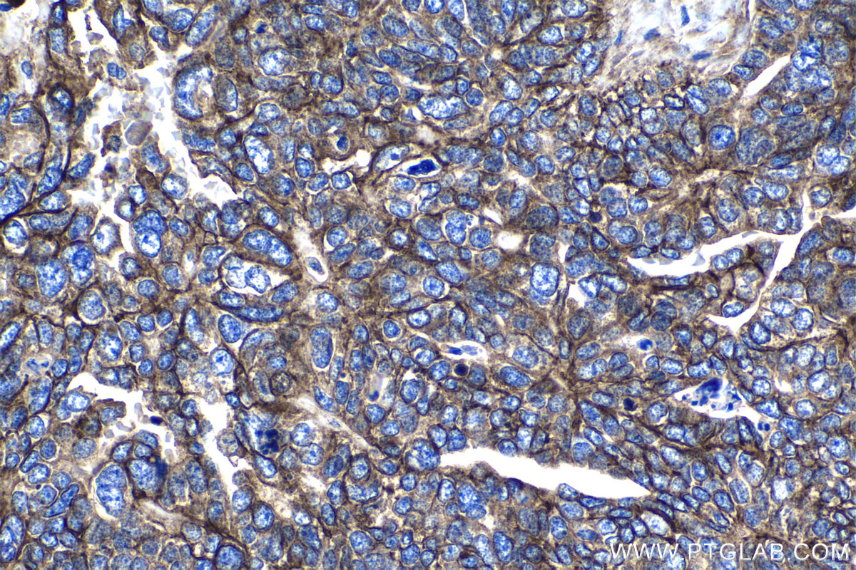 IHC staining of human ovary tumor using 12494-1-AP