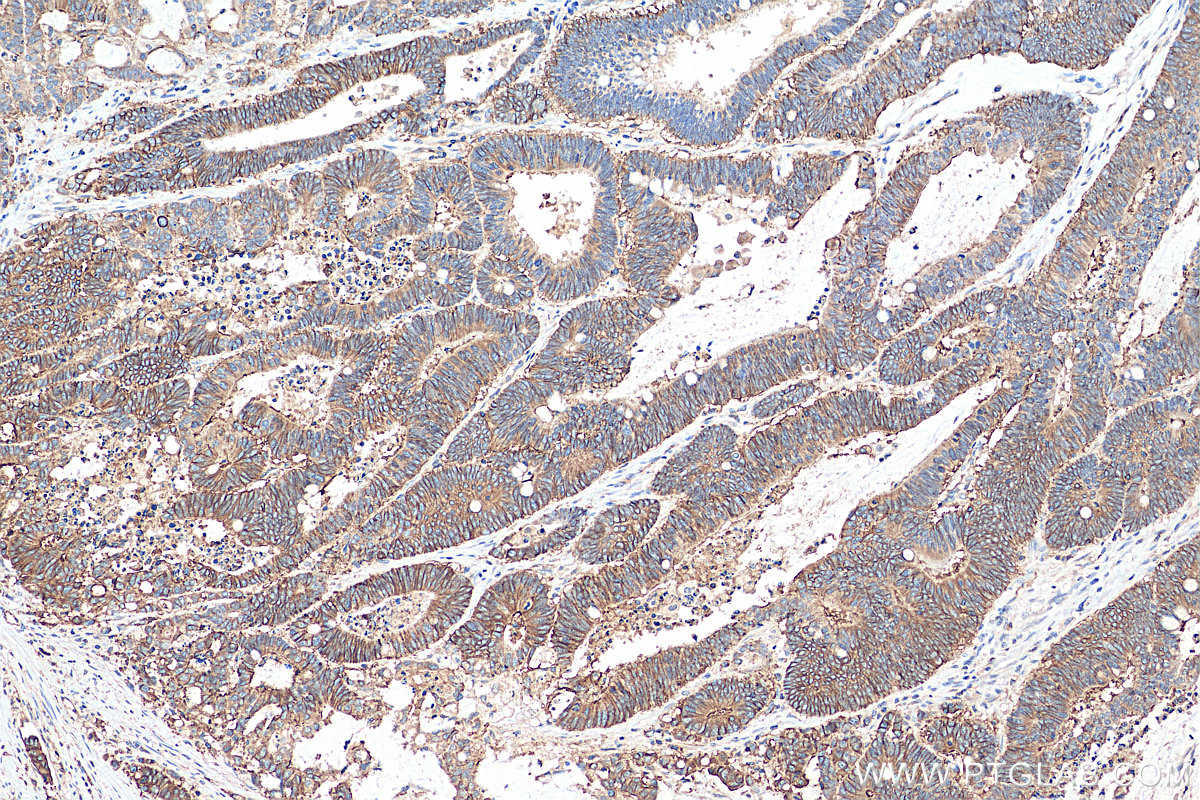 IHC staining of human colon cancer using 28936-1-AP (same clone as 28936-1-PBS)