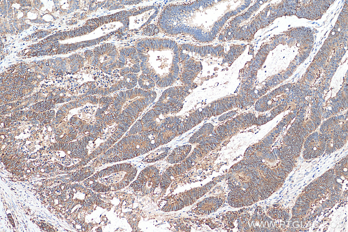 IHC staining of human colon cancer using 28936-1-AP