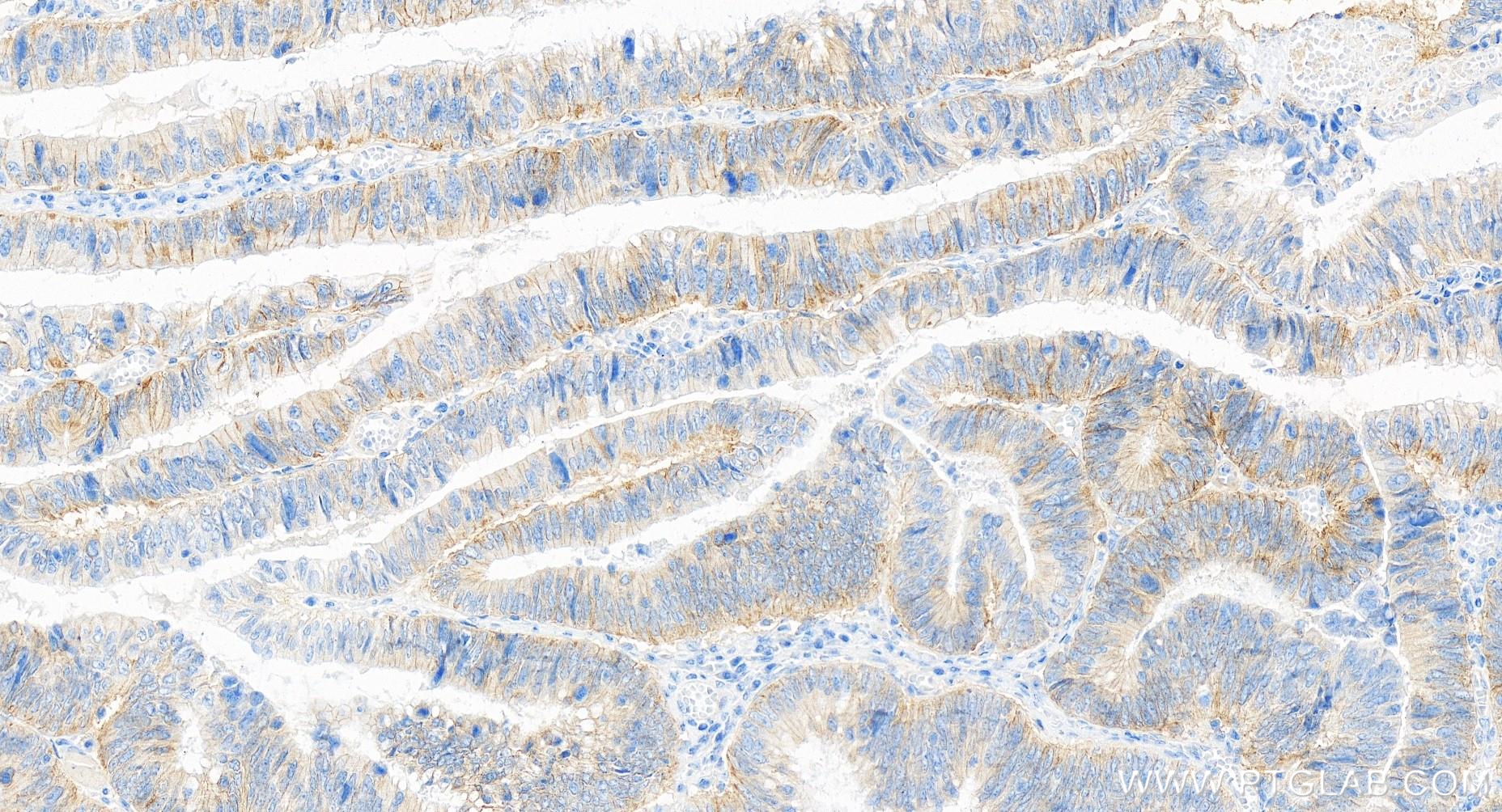 IHC staining of human colon cancer using 84599-5-RR