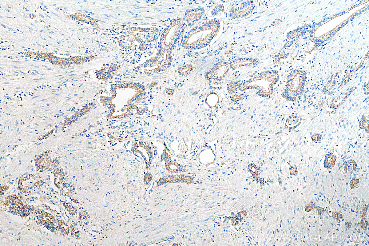 IHC staining of human prostate cancer using 20305-1-AP