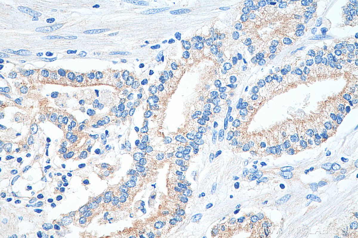 IHC staining of human prostate cancer using 20305-1-AP