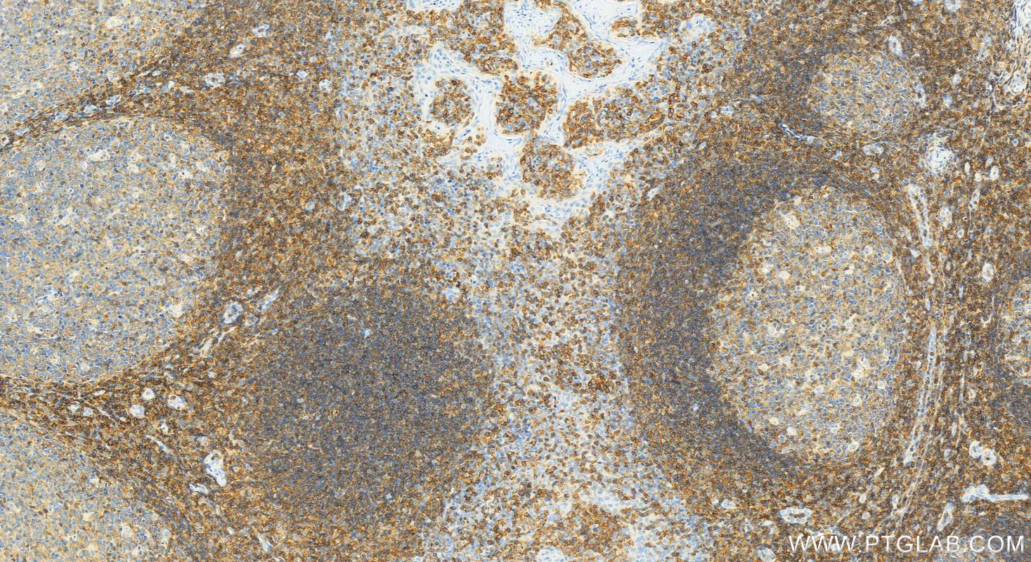 Immunohistochemical analysis of paraffin-embedded human tonsillitis tissue slide using 27519-1-AP (CD48 antibody) at dilution of 1:2000 (under 20x lens). Heat mediated antigen retrieval with Tris-EDTA buffer (pH 9.0). IHC staining of human tonsillitis using 27519-1-AP