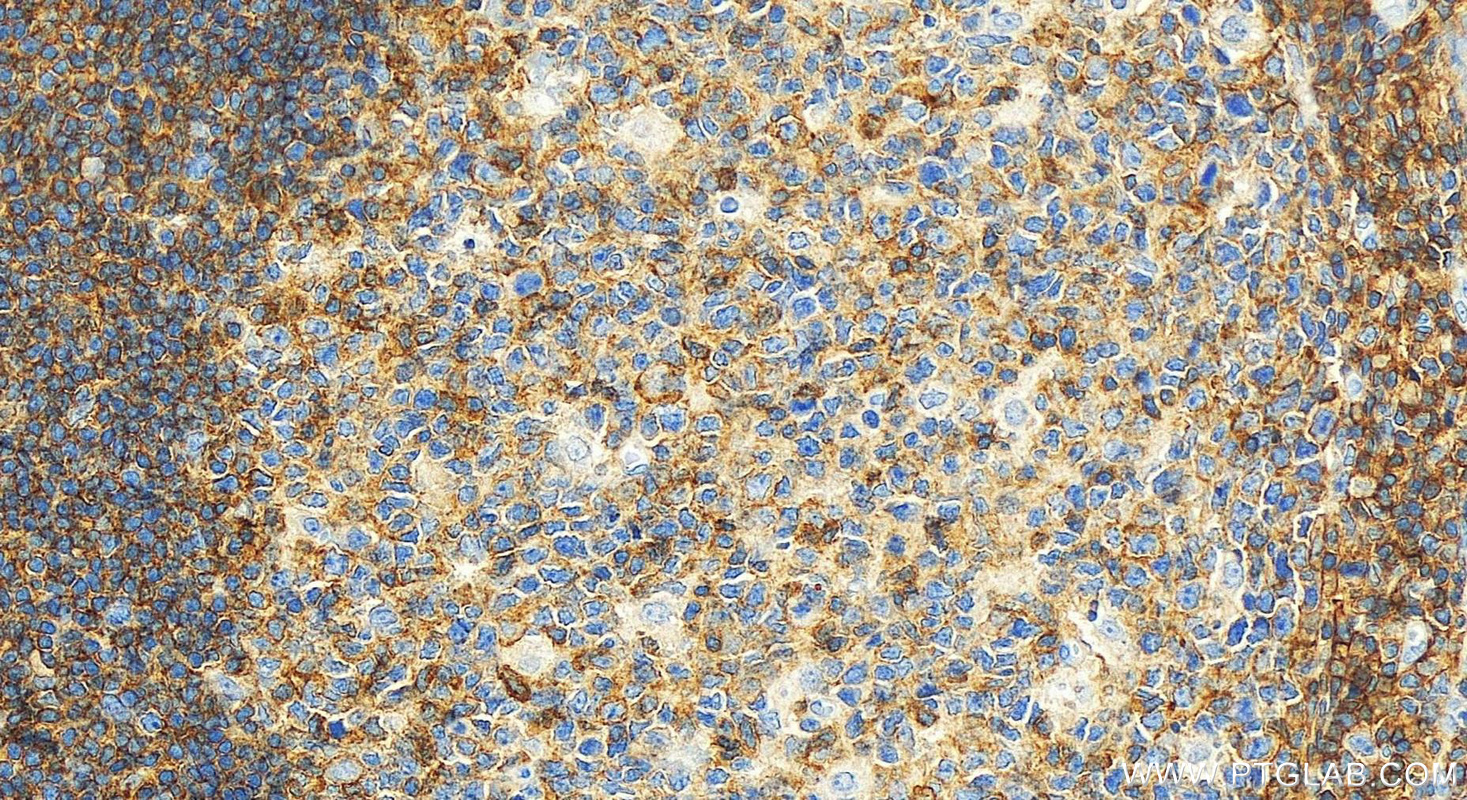 Immunohistochemical analysis of paraffin-embedded human tonsillitis tissue slide using 27519-1-AP (CD48 antibody) at dilution of 1:2000 (under 20x lens). Heat mediated antigen retrieval with Tris-EDTA buffer (pH 9.0). IHC staining of human tonsillitis using 27519-1-AP