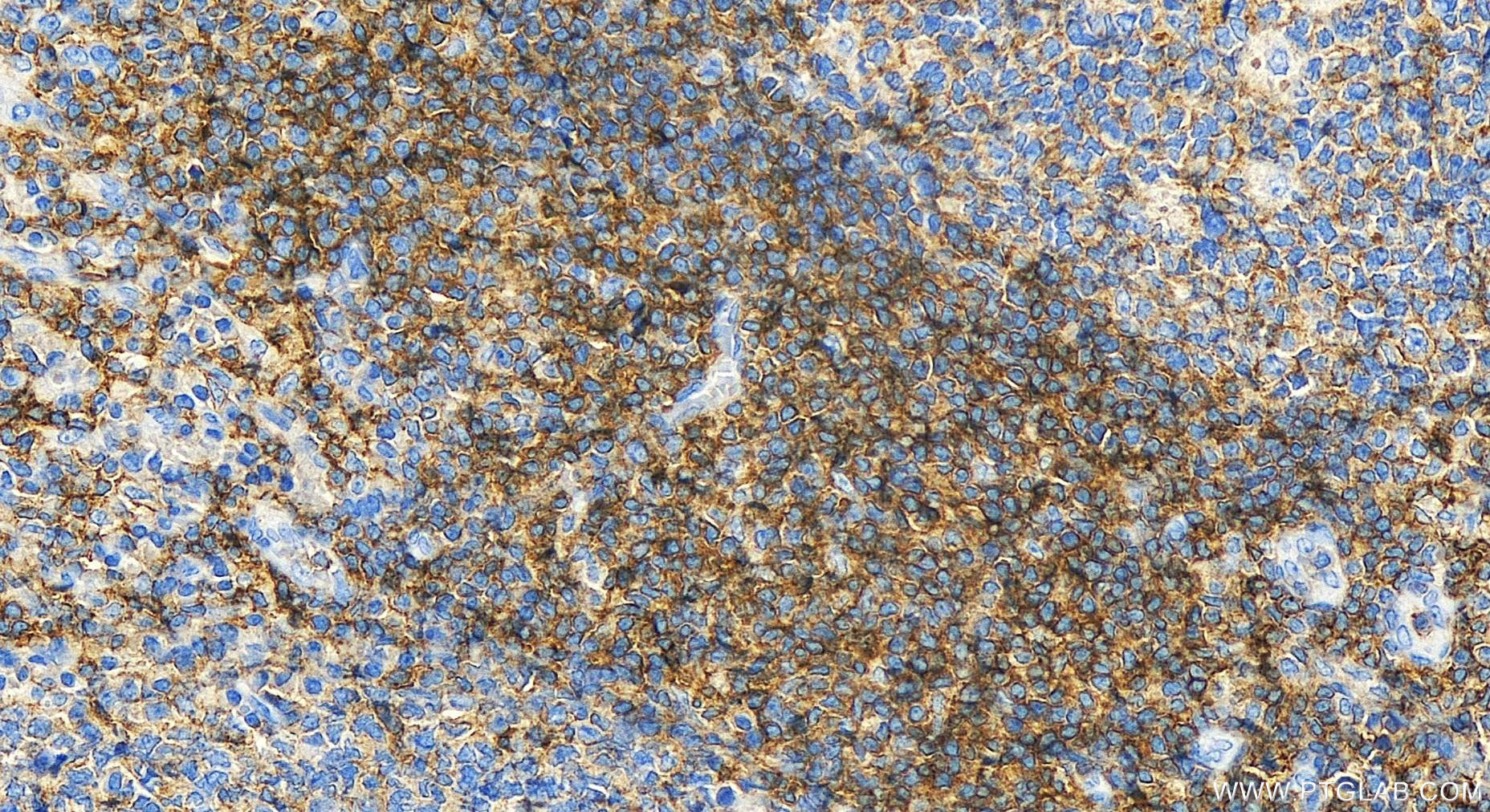 IHC staining of human tonsillitis using 31945-1-AP
