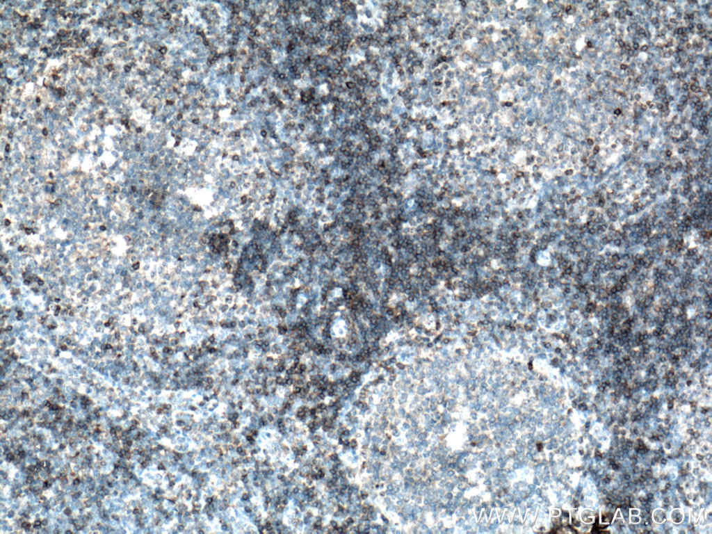 IHC staining of human tonsillitis using 17227-1-AP