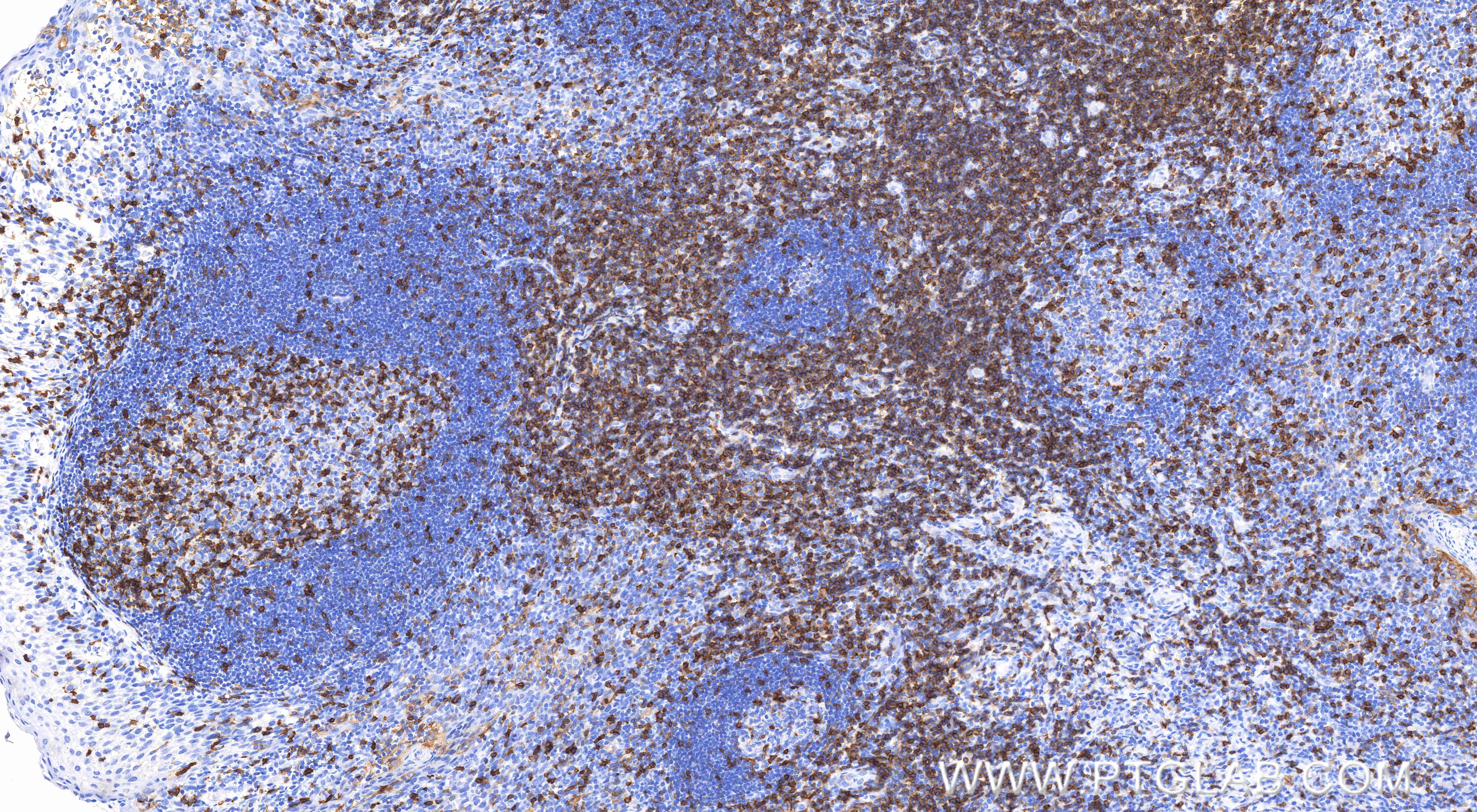 Immunohistochemical analysis of paraffin-embedded human tonsil tissue slide using 83543-7-RR (CD5 antibody) at dilution of 1:3000 (under 10x lens). Heat mediated antigen retrieval with Tris-EDTA buffer (pH 9.0). IHC staining of human tonsil using 83543-7-RR