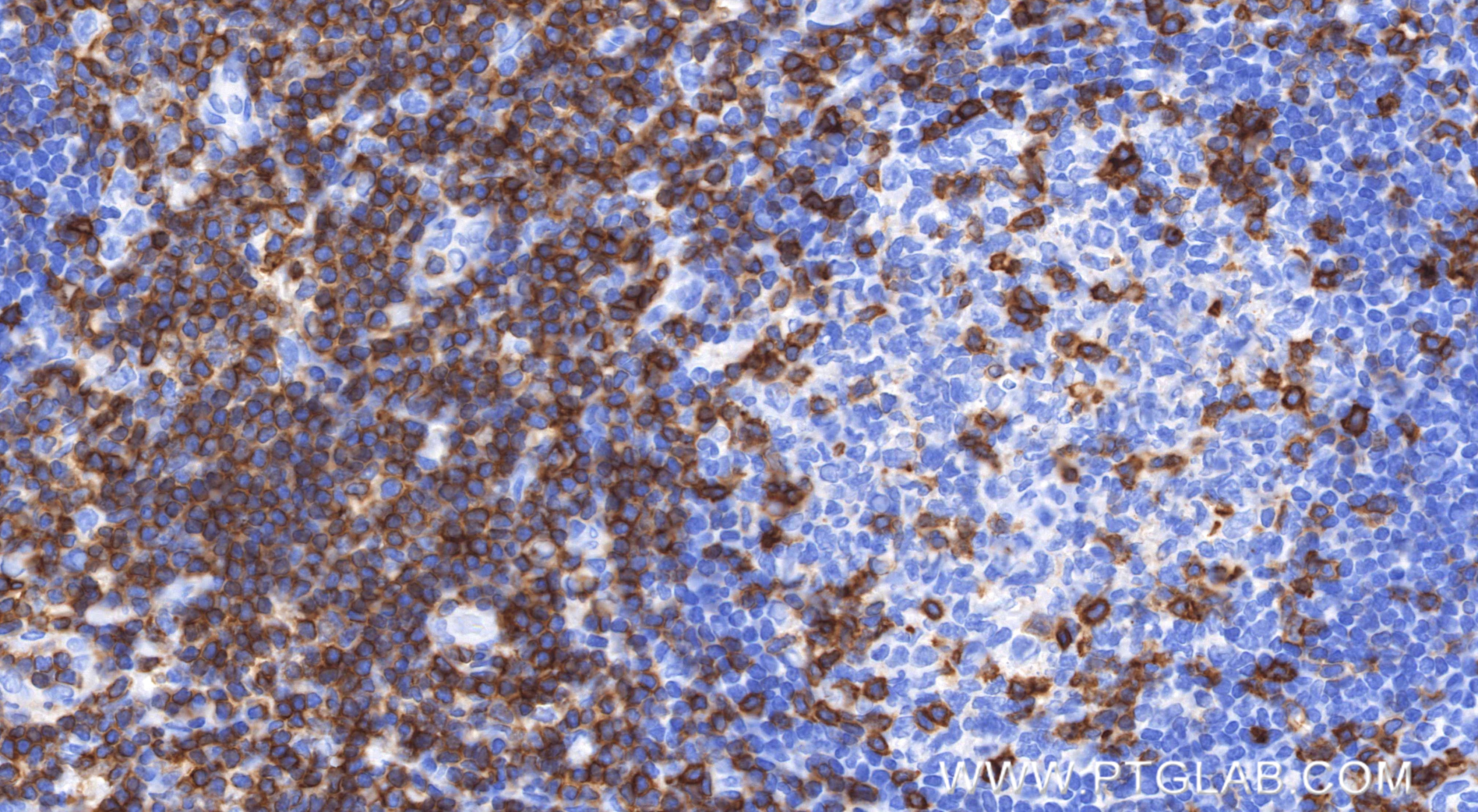 Immunohistochemical analysis of paraffin-embedded human tonsil tissue slide using 83543-7-RR (CD5 antibody) at dilution of 1:3000 (under 40x lens). Heat mediated antigen retrieval with Tris-EDTA buffer (pH 9.0). IHC staining of human tonsil using 83543-7-RR