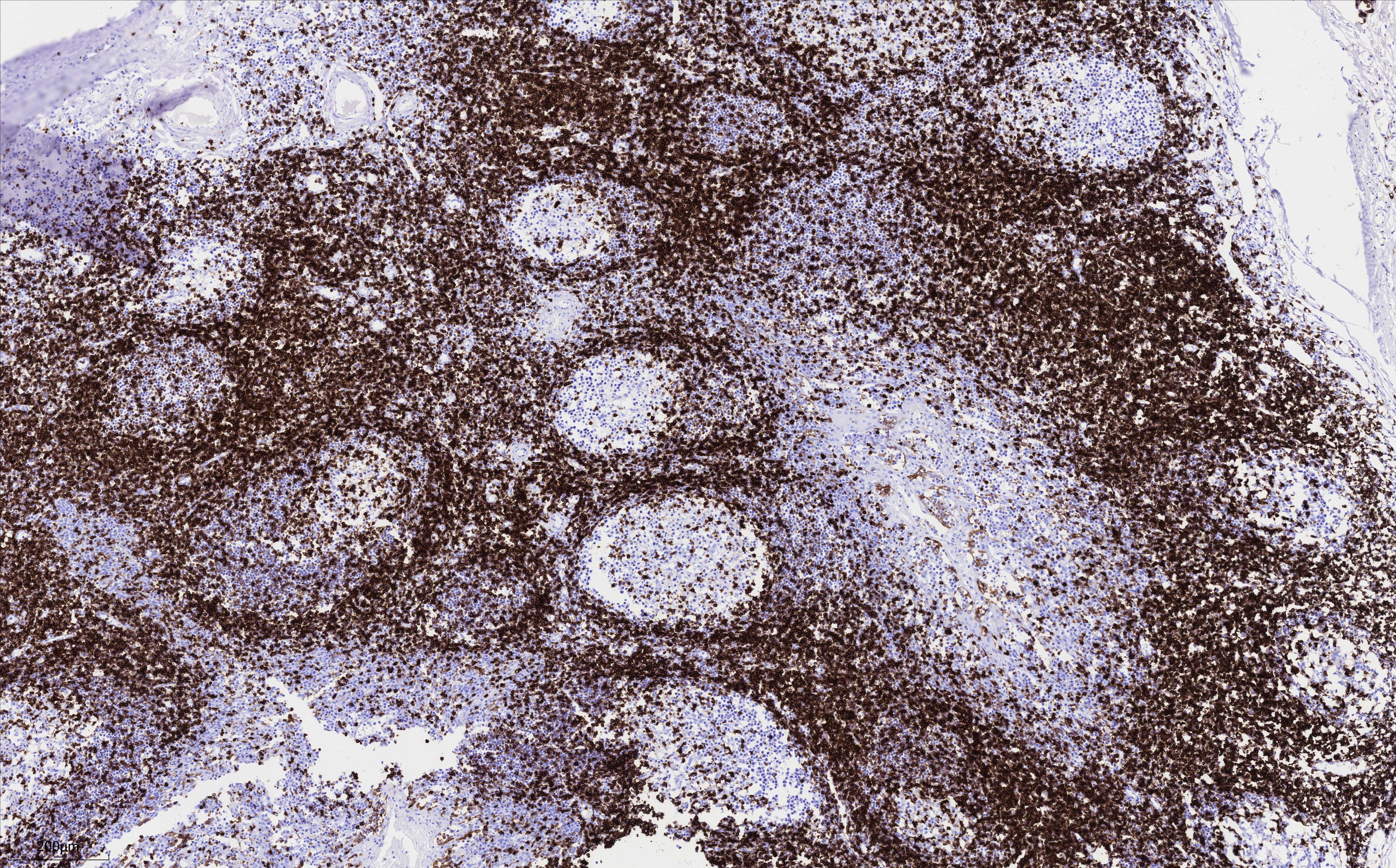 IHC staining of human tonsillitis using 83543-7-RR