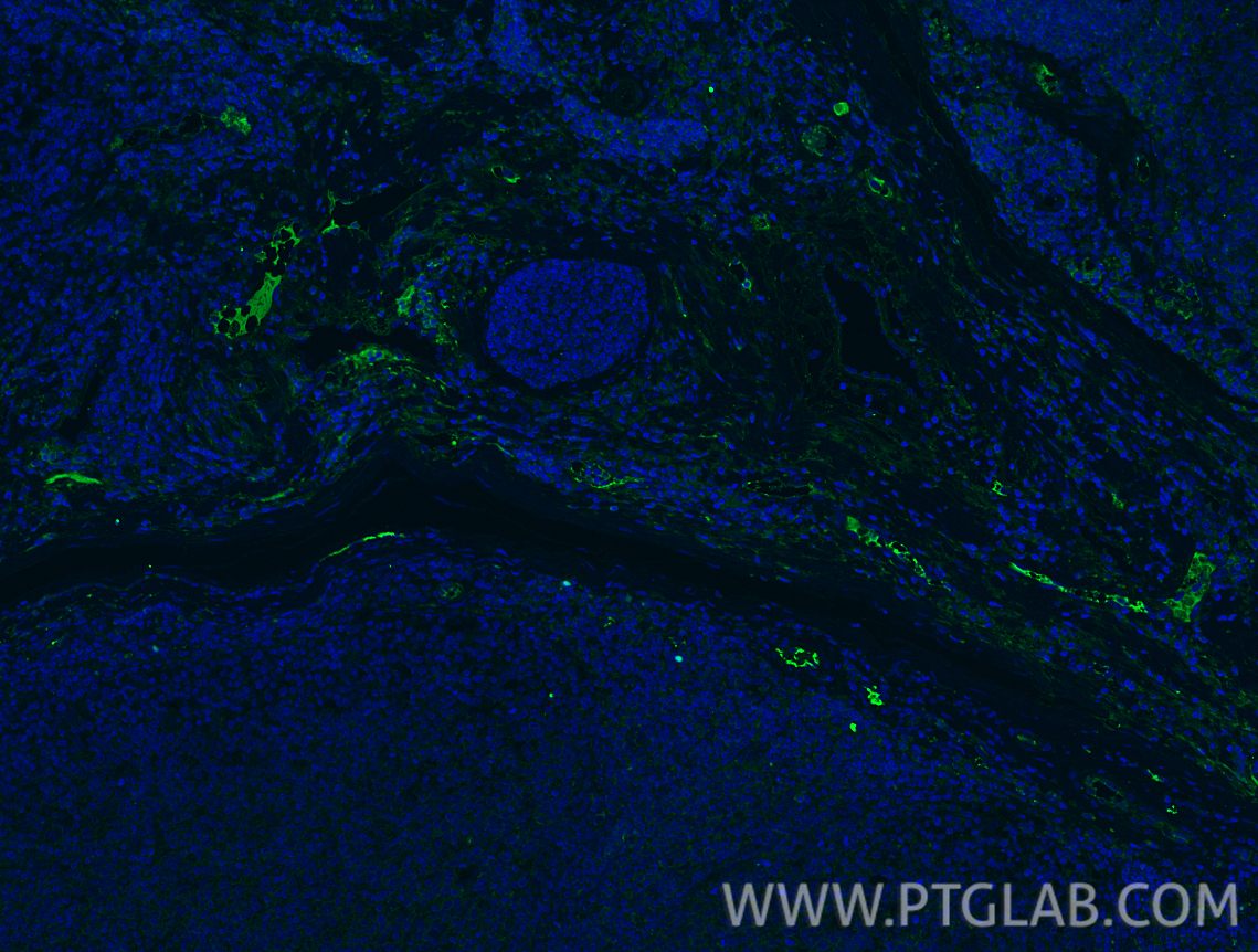 IF Staining of human tonsillitis using 21809-1-AP IF Staining of human tonsillitis using 21809-1-AP