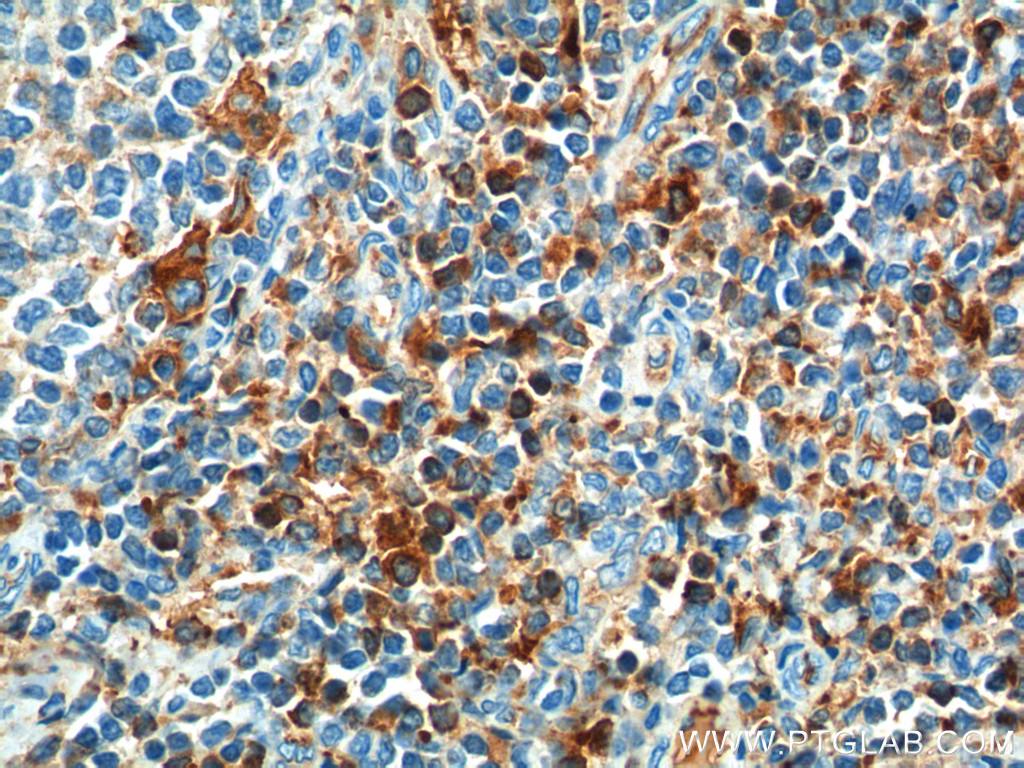 IHC staining of human tonsillitis using 21809-1-AP