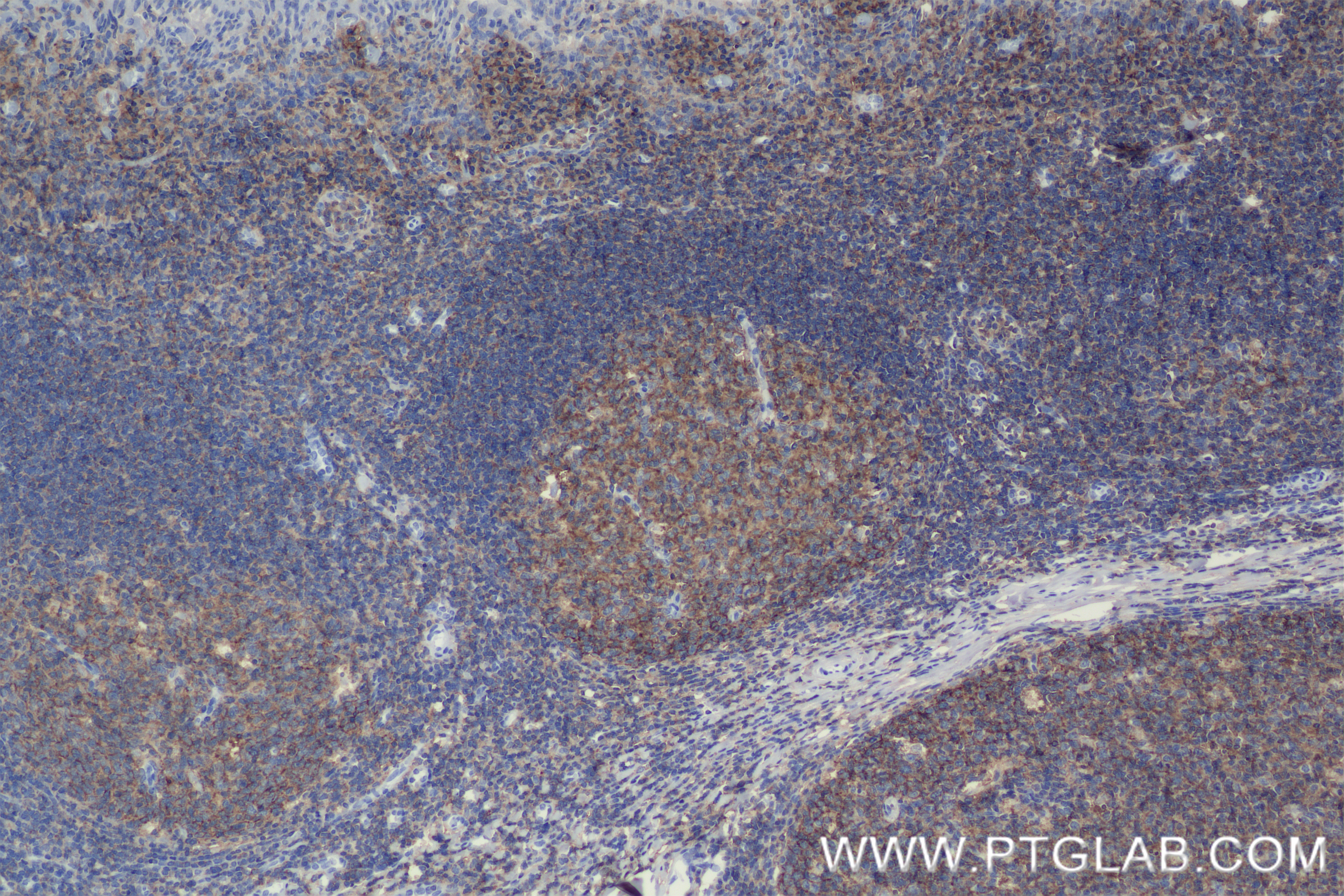 IHC staining of human tonsillitis using 84837-1-RR