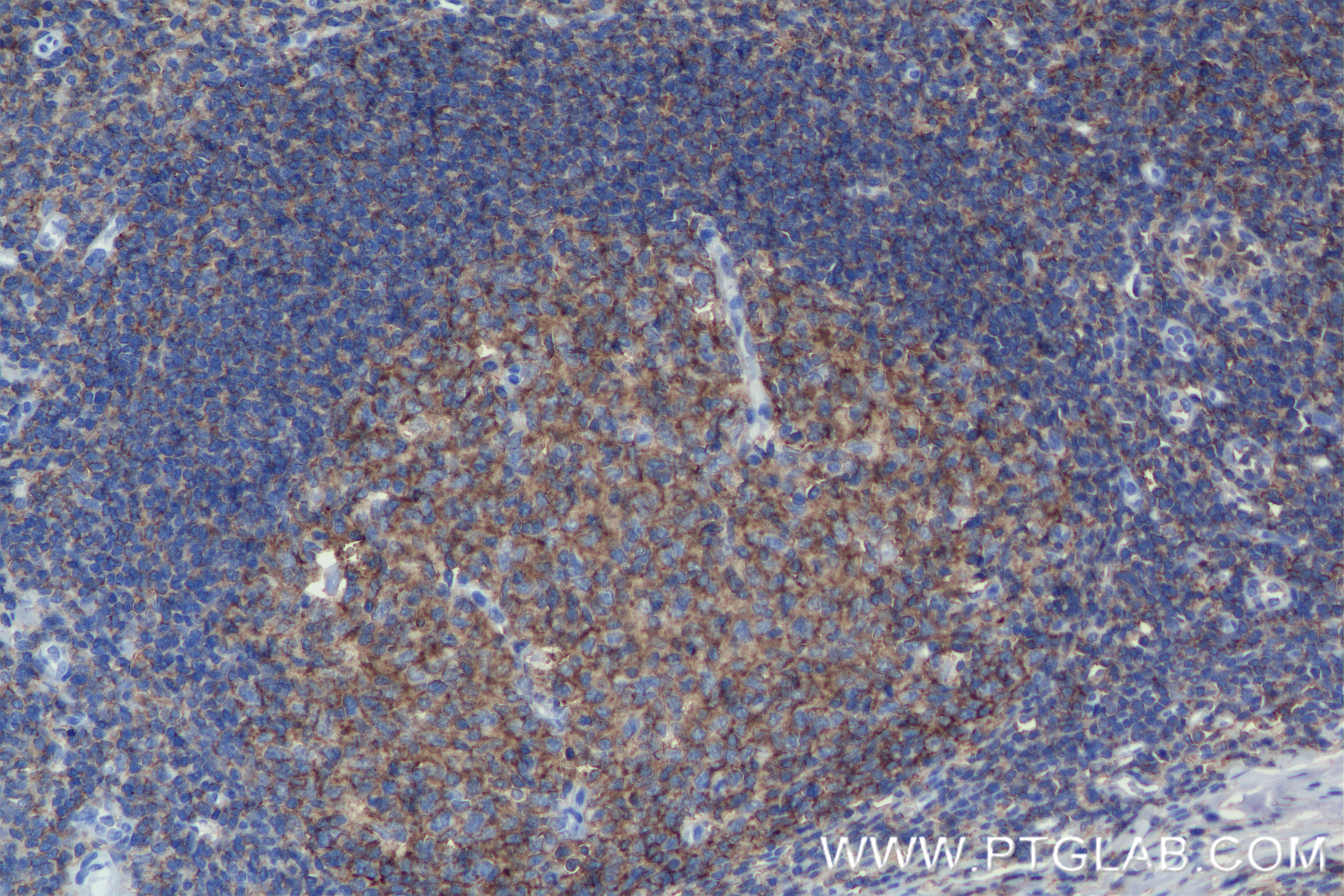 IHC staining of human tonsillitis using 84837-1-RR