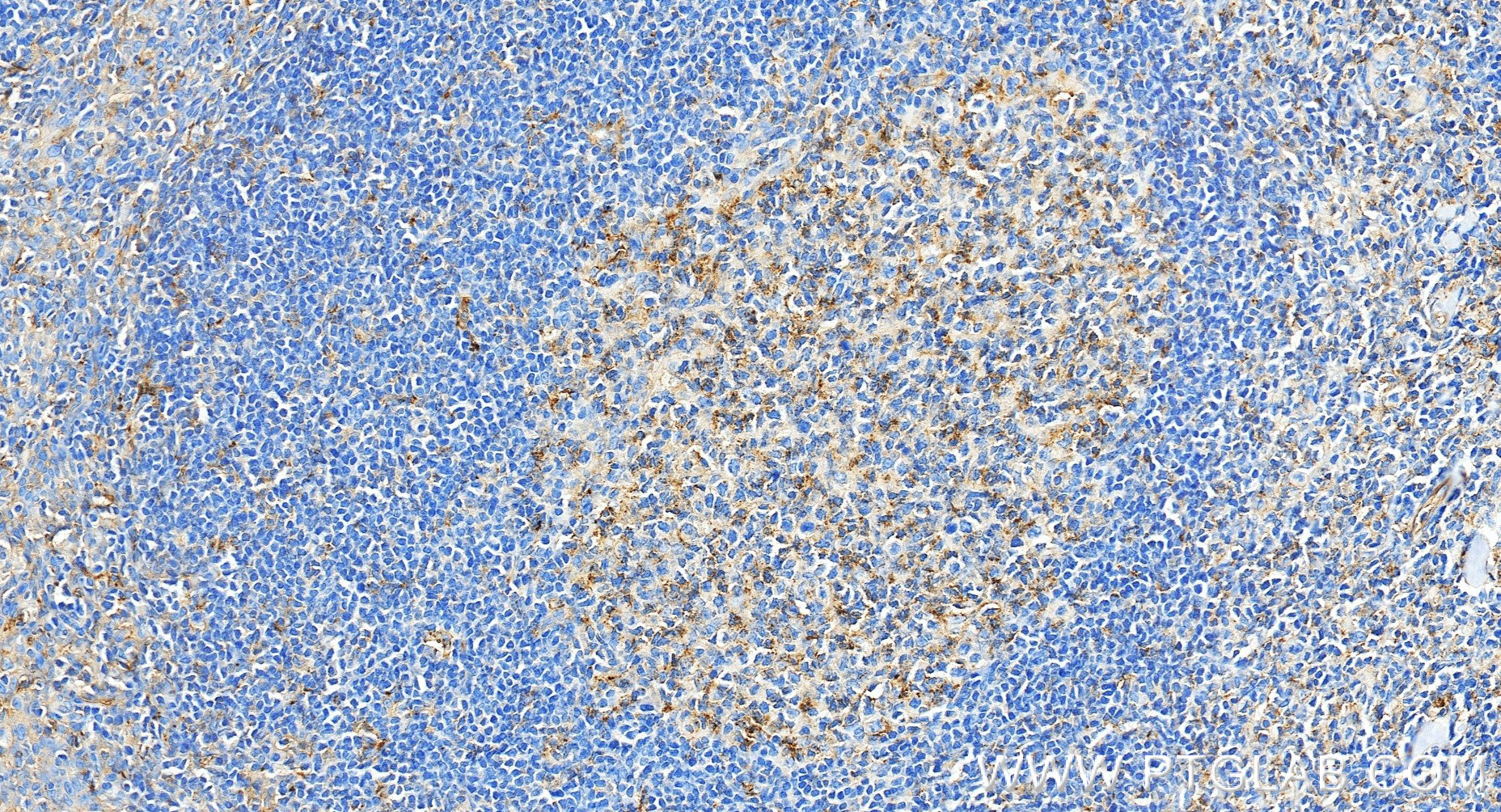 IHC staining of human tonsillitis using 85950-1-RR