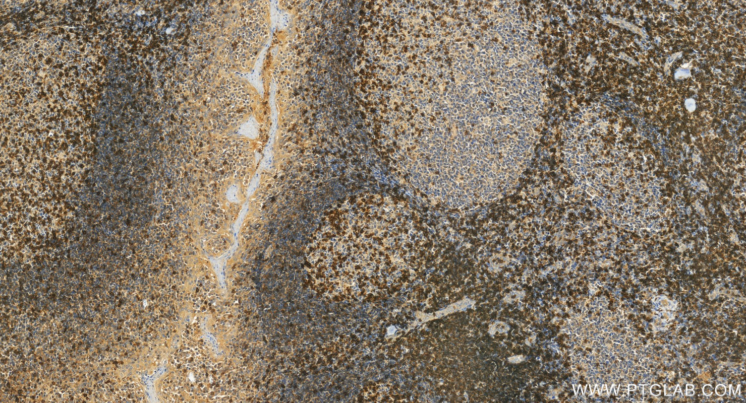 IHC staining of human tonsillitis using 16763-1-AP