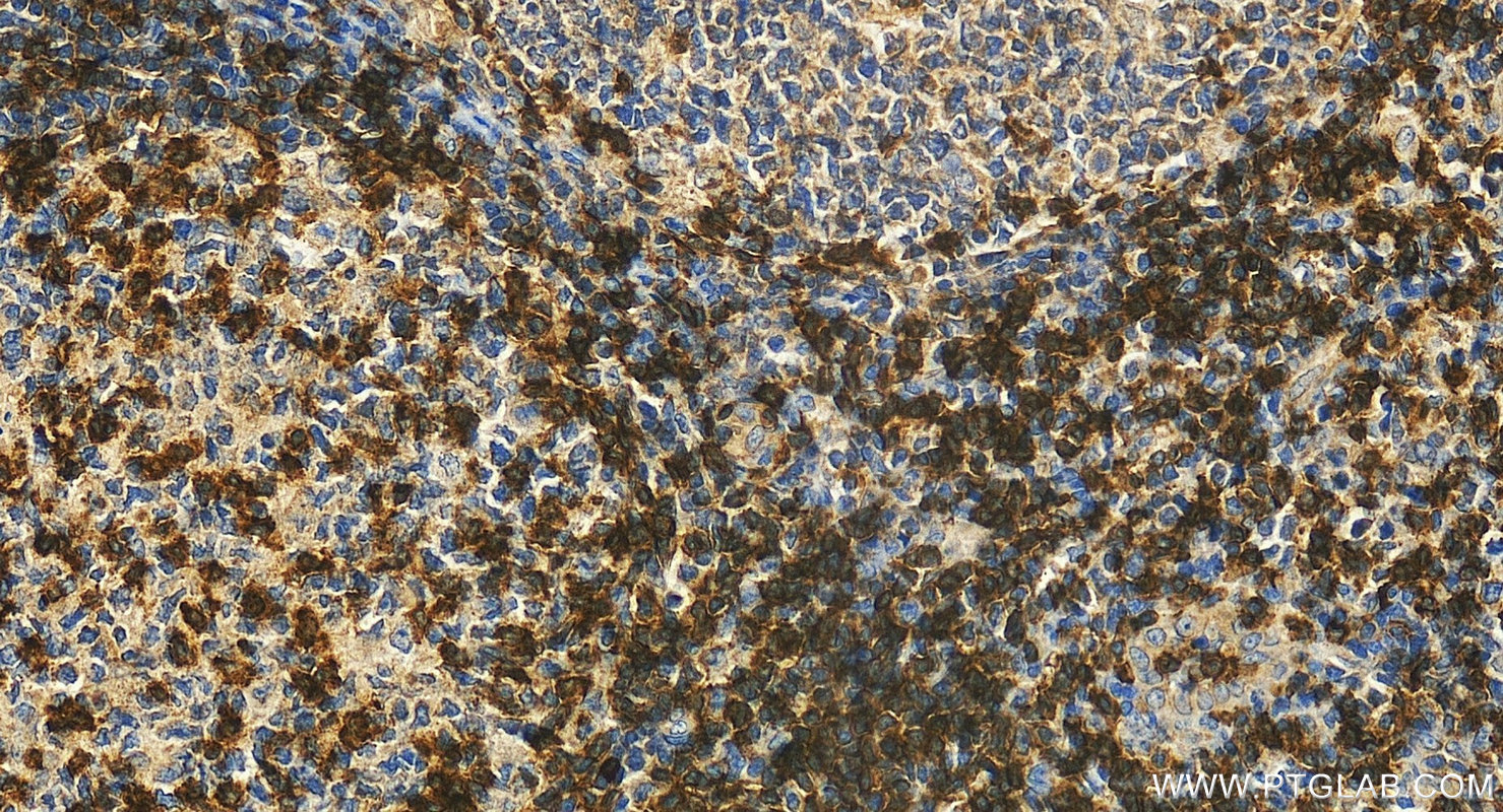 IHC staining of human tonsillitis using 16763-1-AP