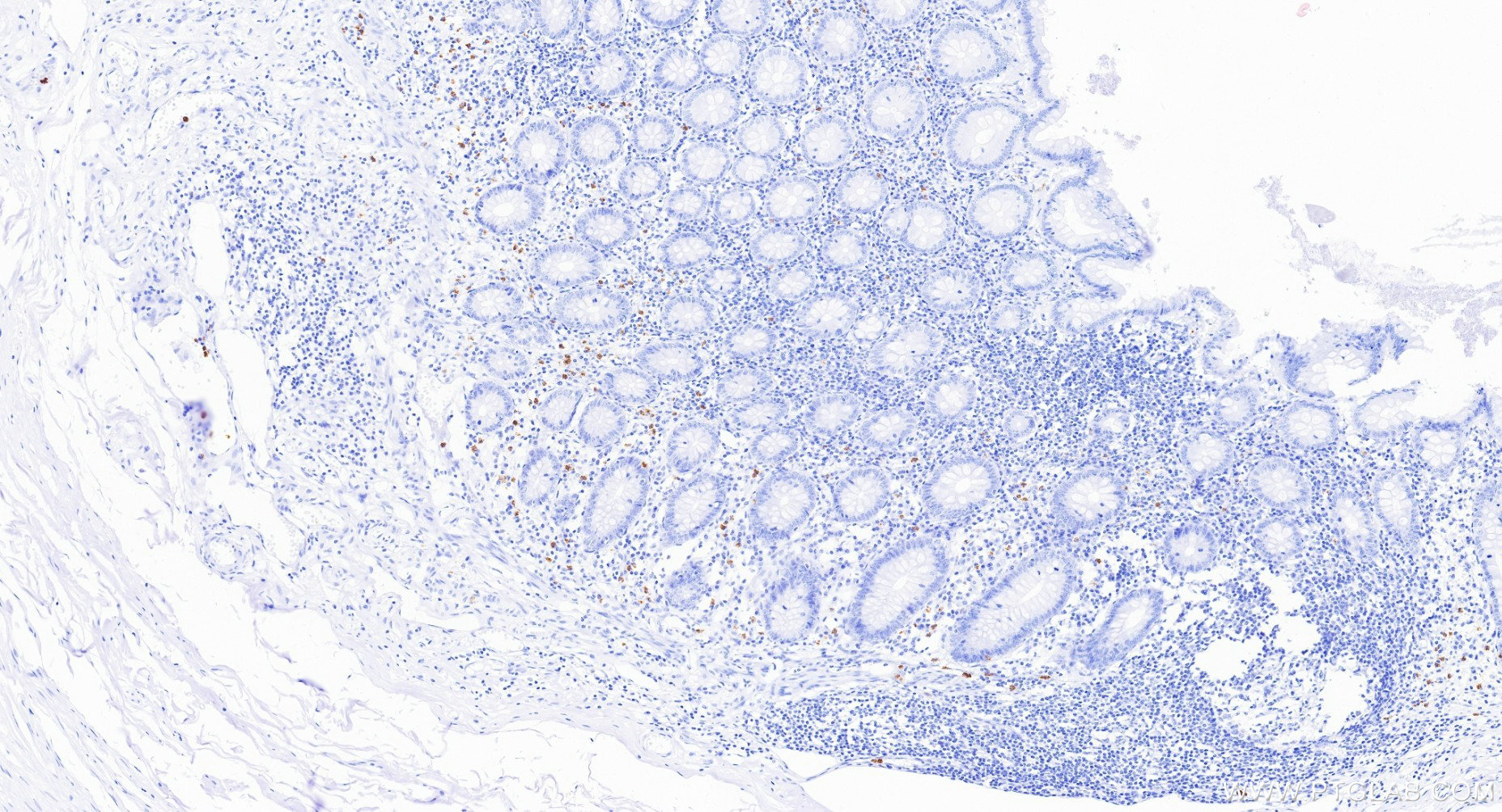IHC staining of human appendicitis using 85111-6-RR (same clone as 85111-6-PBS) IHC staining of human appendicitis using 85111-6-RR (same clone as 85111-6-PBS)