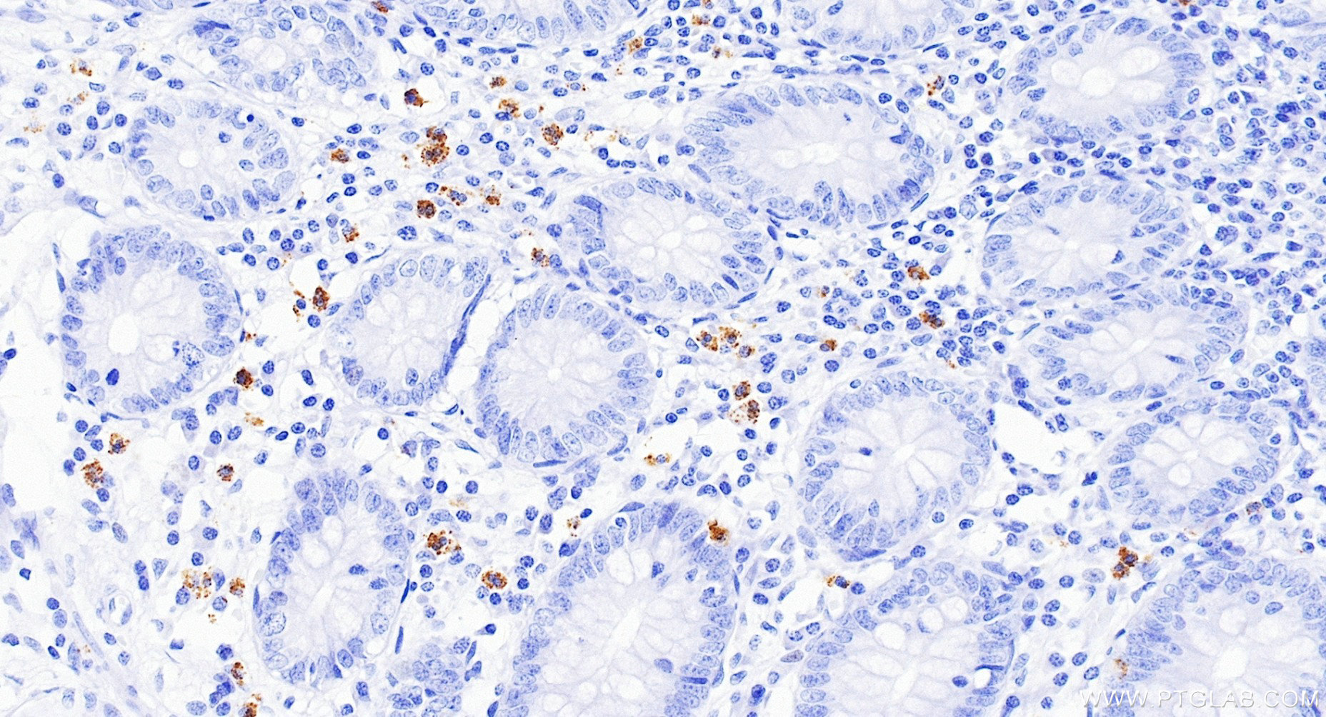 IHC staining of human appendicitis using 85111-6-RR (same clone as 85111-6-PBS) IHC staining of human appendicitis using 85111-6-RR (same clone as 85111-6-PBS)