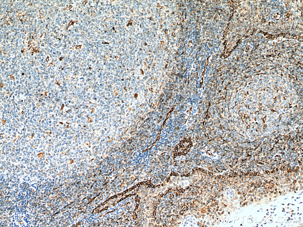IHC staining of human tonsillitis using 67605-1-Ig (same clone as 67605-1-PBS)