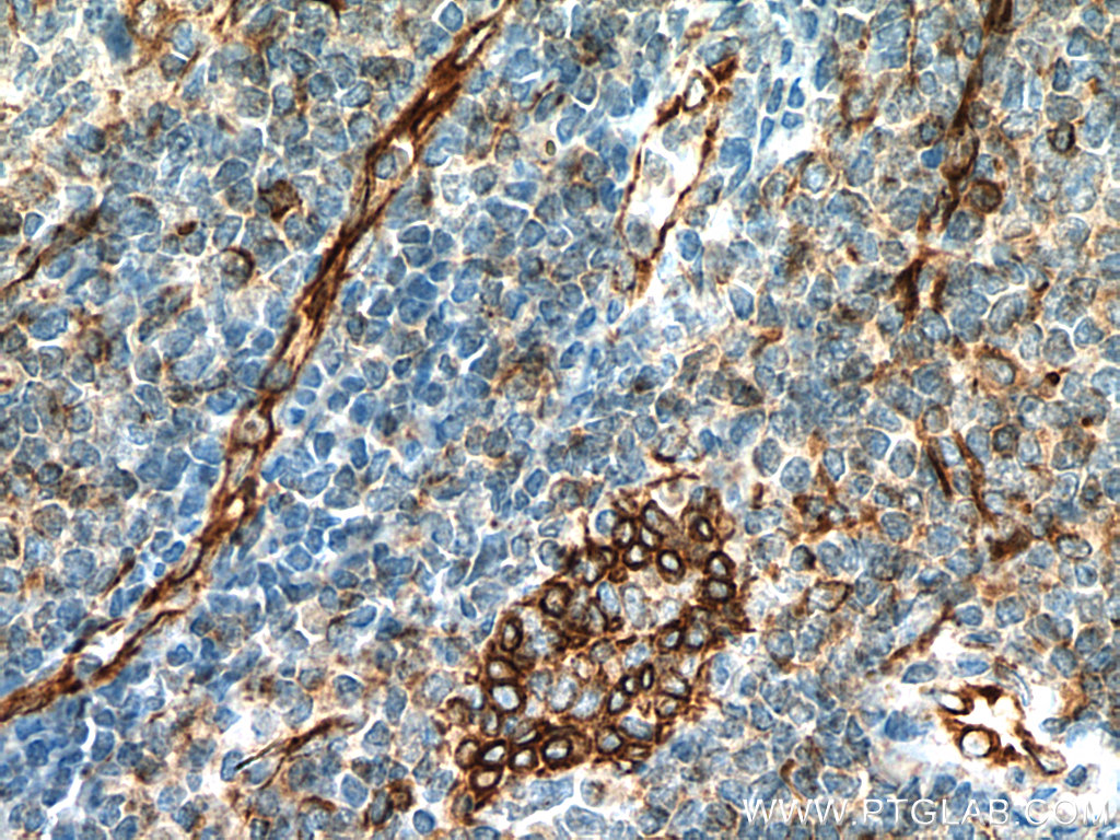 IHC staining of human tonsillitis using 67605-1-Ig (same clone as 67605-1-PBS)