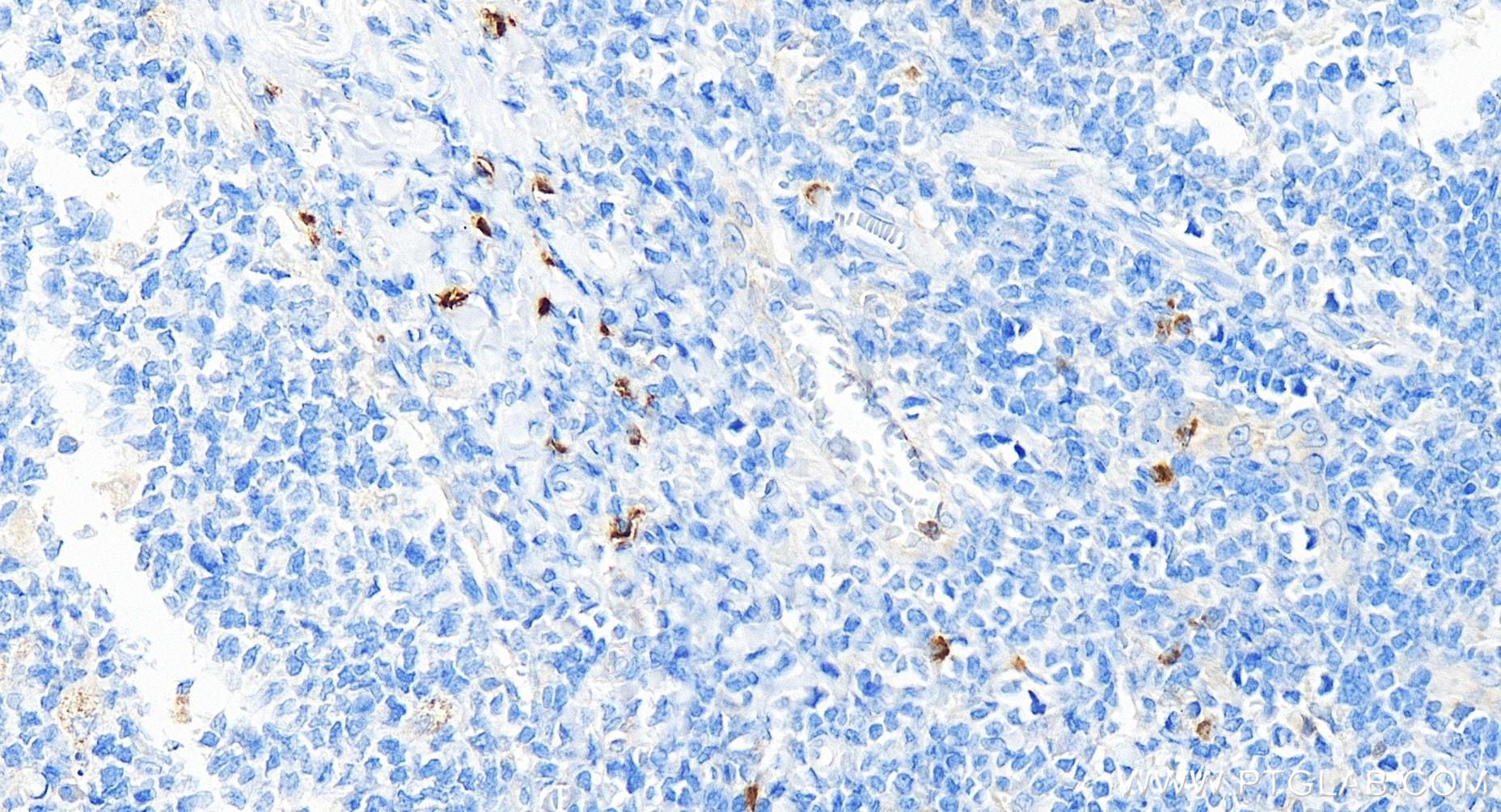 IHC staining of human tonsillitis using 84507-4-RR