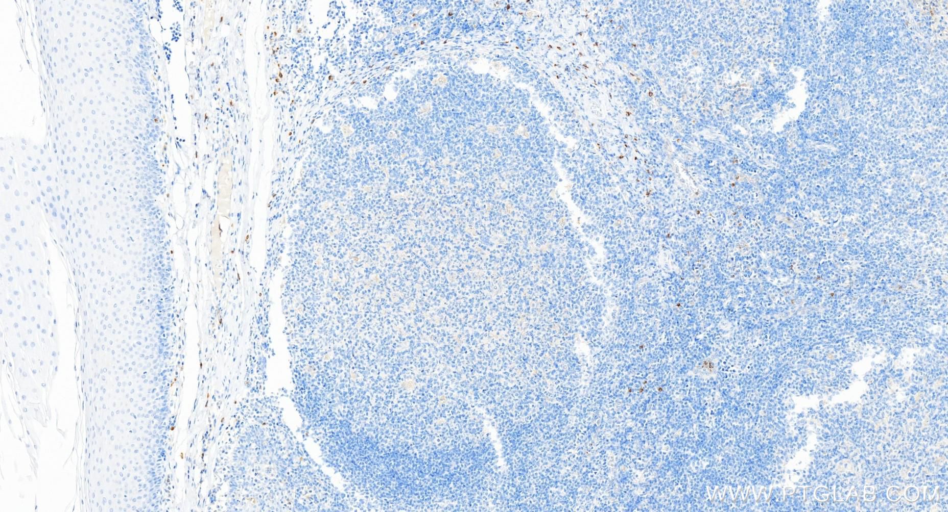 IHC staining of human tonsillitis using 84507-4-RR