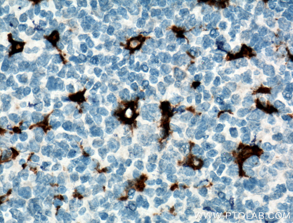 IHC staining of human tonsillitis using 66231-2-Ig