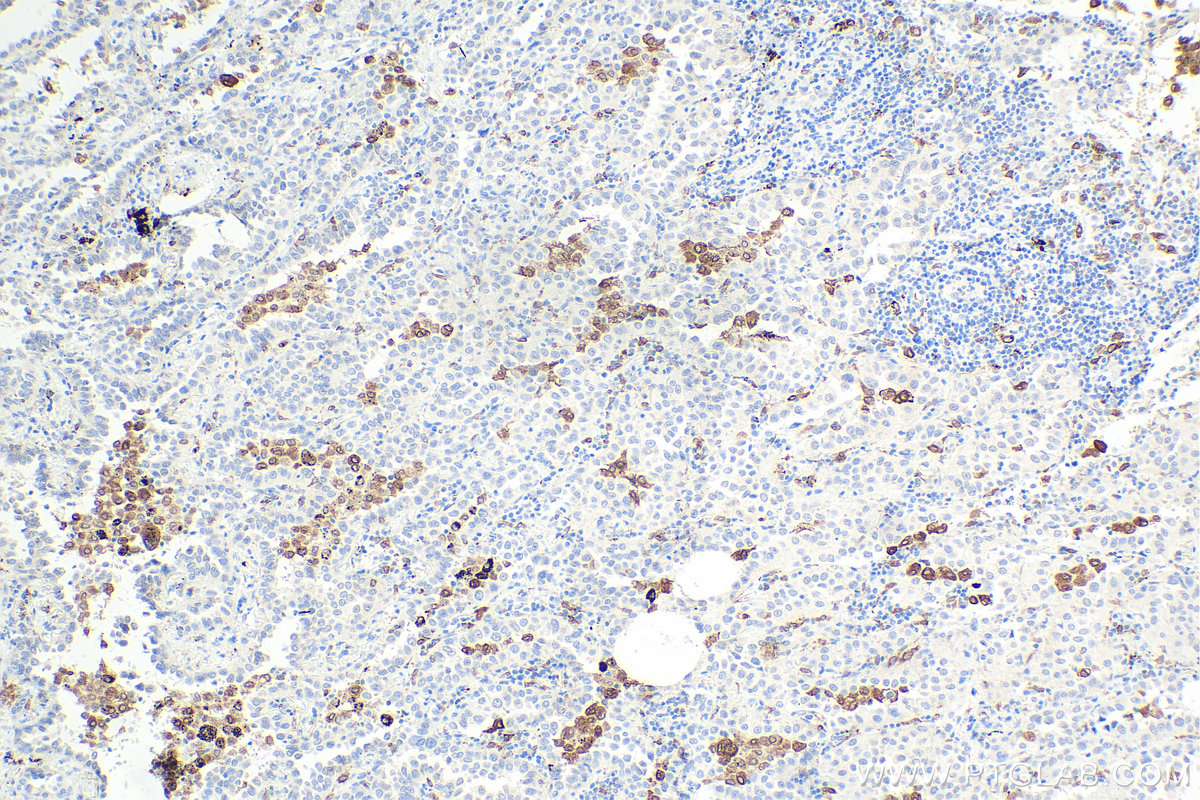 IHC staining of human lung cancer using 66231-2-Ig