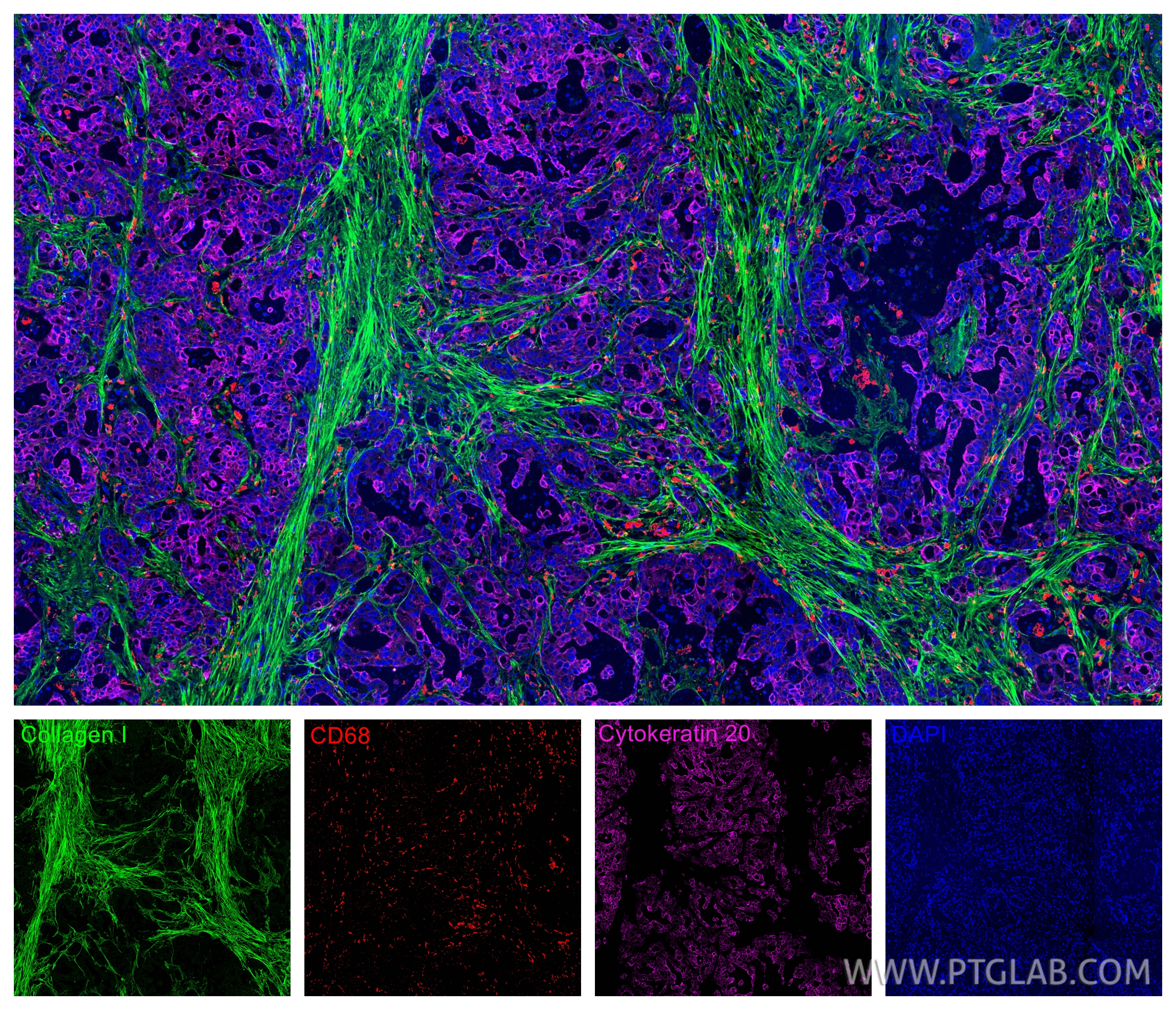 IF Staining of human colon cancer using CL594-25747 IF Staining of human colon cancer using CL594-25747
