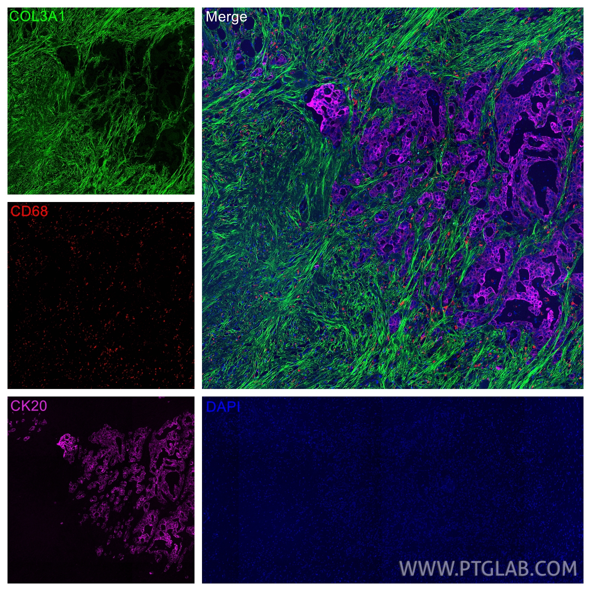 IF Staining of human colon cancer using CL594-25747 IF Staining of human colon cancer using CL594-25747