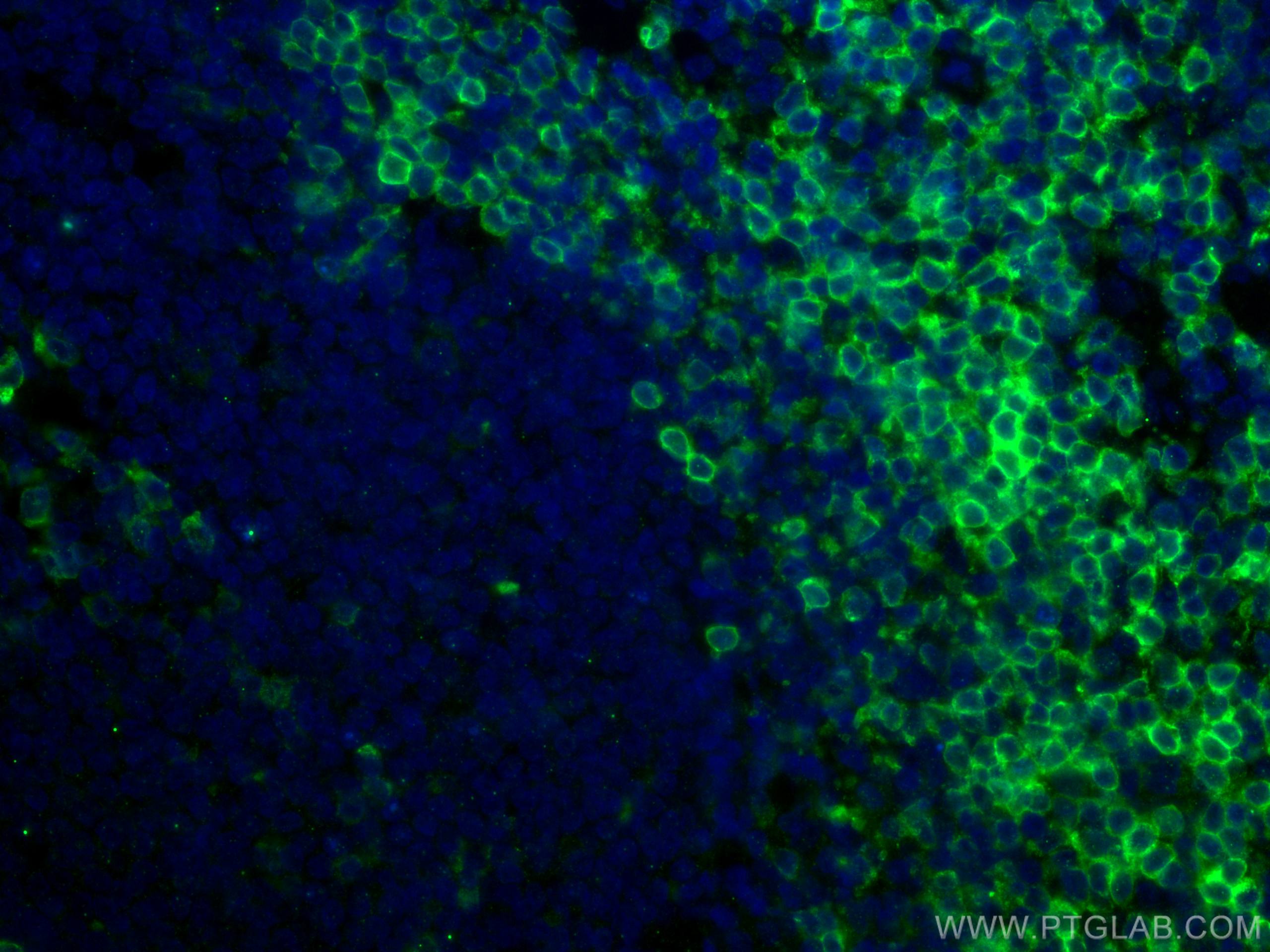 IF Staining of human tonsillitis using 60209-1-Ig