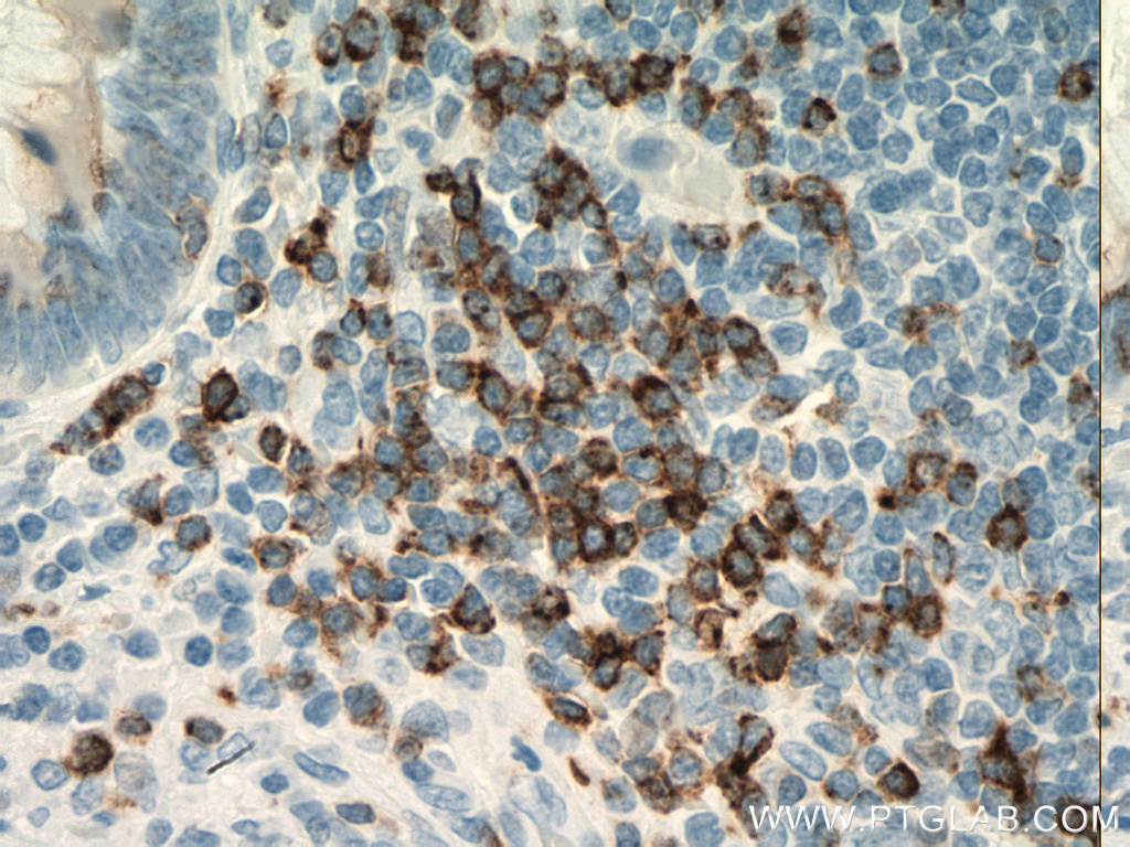 IHC staining of human appendicitis using 60209-1-Ig