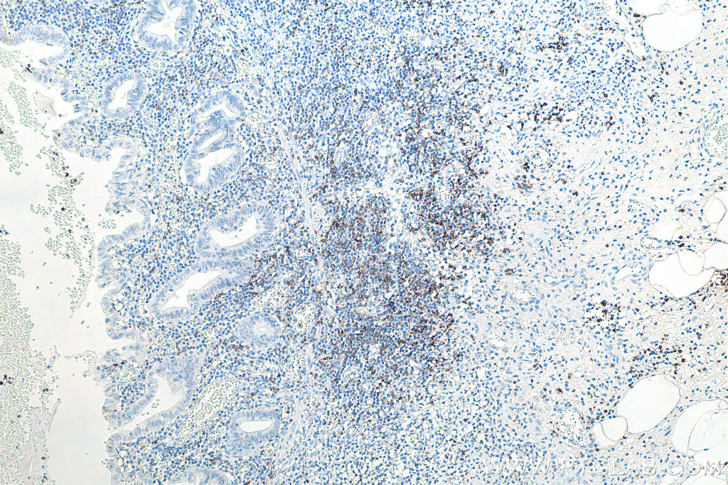 IHC staining of human appendicitis using 60209-2-Ig IHC staining of human appendicitis using 60209-2-Ig