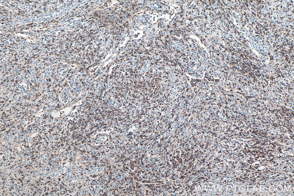 IHC staining of human lymphoma using 60209-2-Ig IHC staining of human lymphoma using 60209-2-Ig