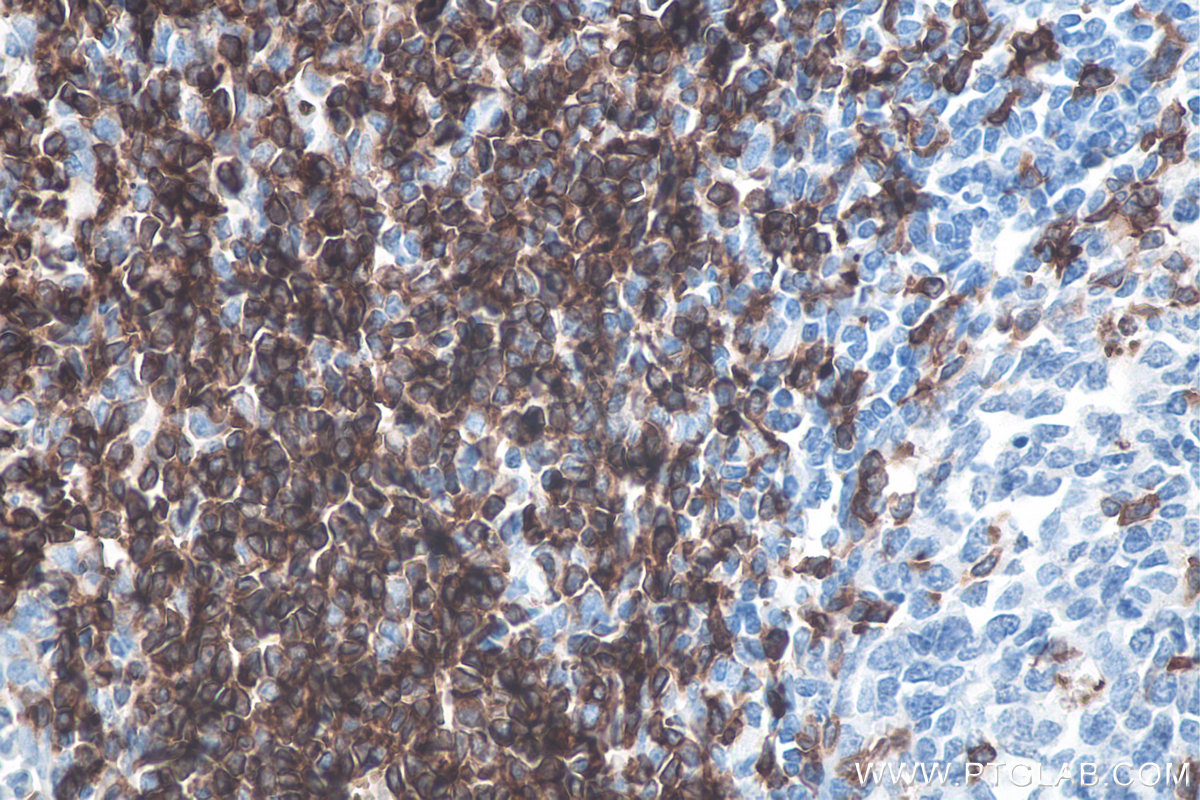 IHC staining of human tonsillitis using 60209-2-Ig