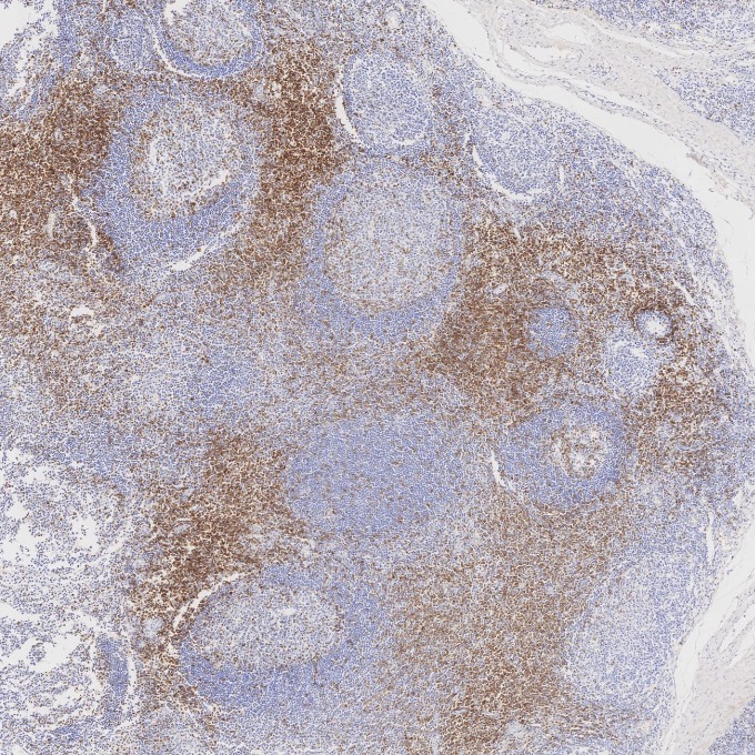 IHC staining of human tonsillitis using 60209-2-Ig IHC staining of human tonsillitis using 60209-2-Ig