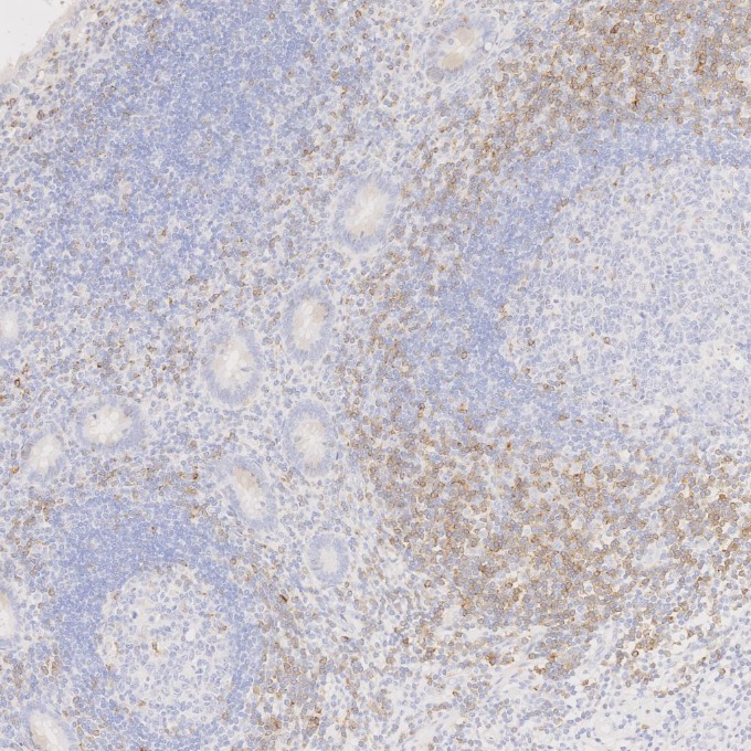 IHC staining of human appendicitis using 60209-2-Ig IHC staining of human appendicitis using 60209-2-Ig