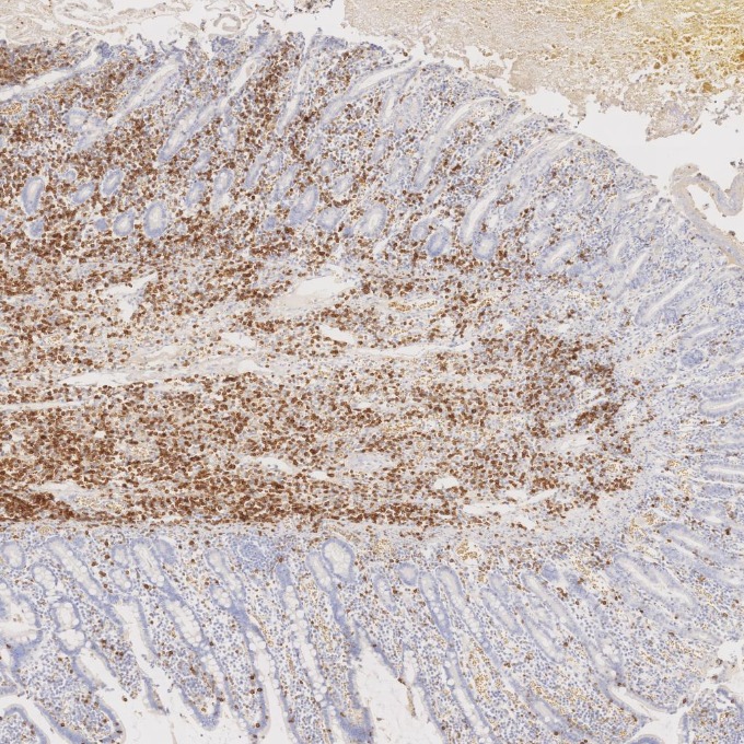 IHC staining of human lymphoma using 60209-2-Ig IHC staining of human lymphoma using 60209-2-Ig