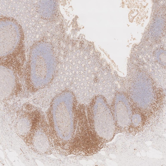 IHC staining of human appendicitis using 60209-2-Ig IHC staining of human appendicitis using 60209-2-Ig