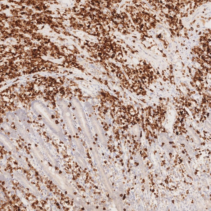 IHC staining of human lymphoma using 60209-2-Ig IHC staining of human lymphoma using 60209-2-Ig