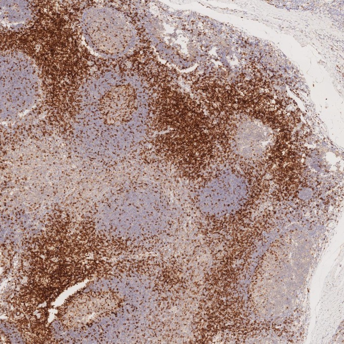 IHC staining of human tonsillitis using 60209-2-Ig IHC staining of human tonsillitis using 60209-2-Ig