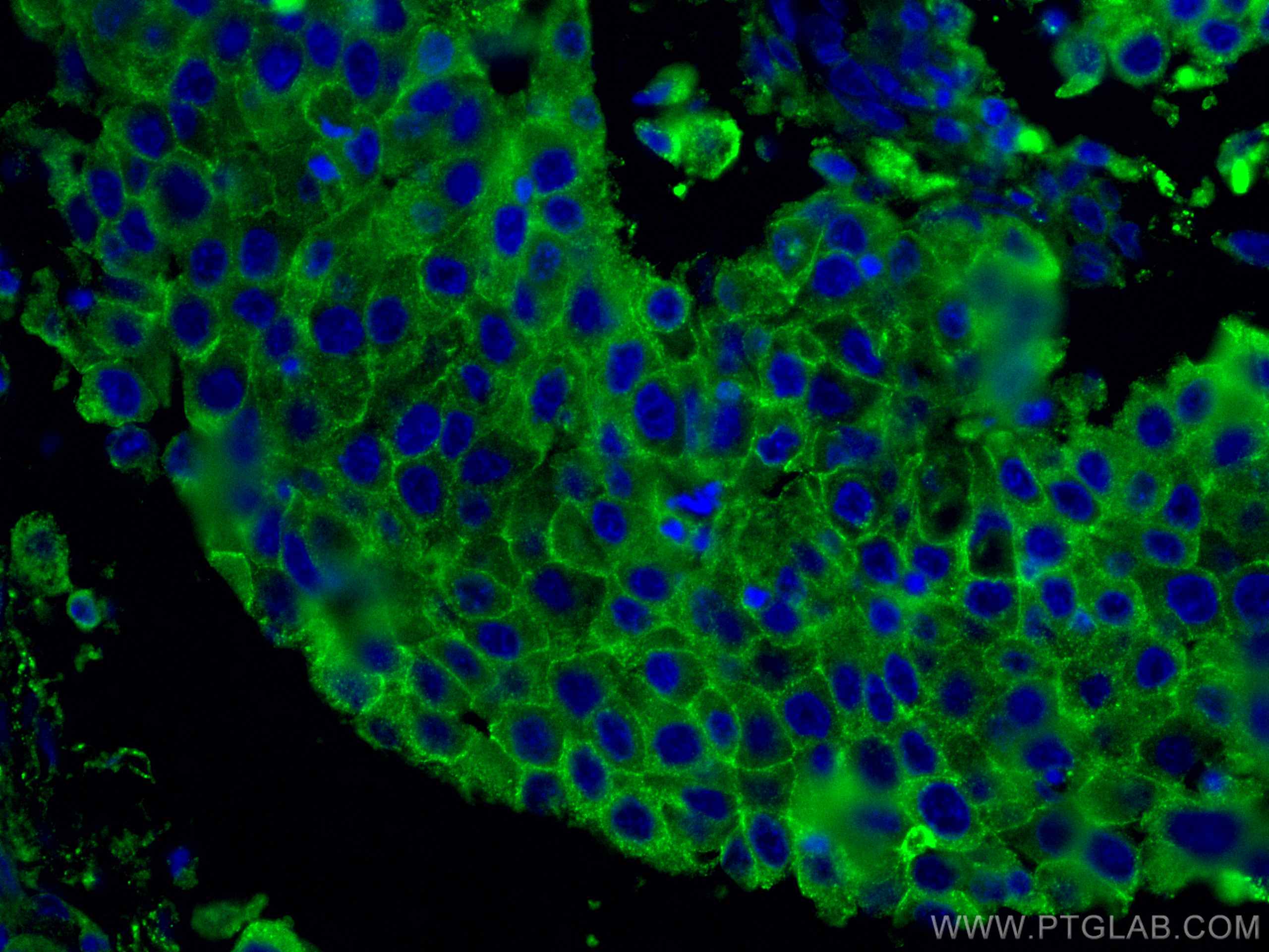 IF Staining of human breast cancer using 66180-1-Ig