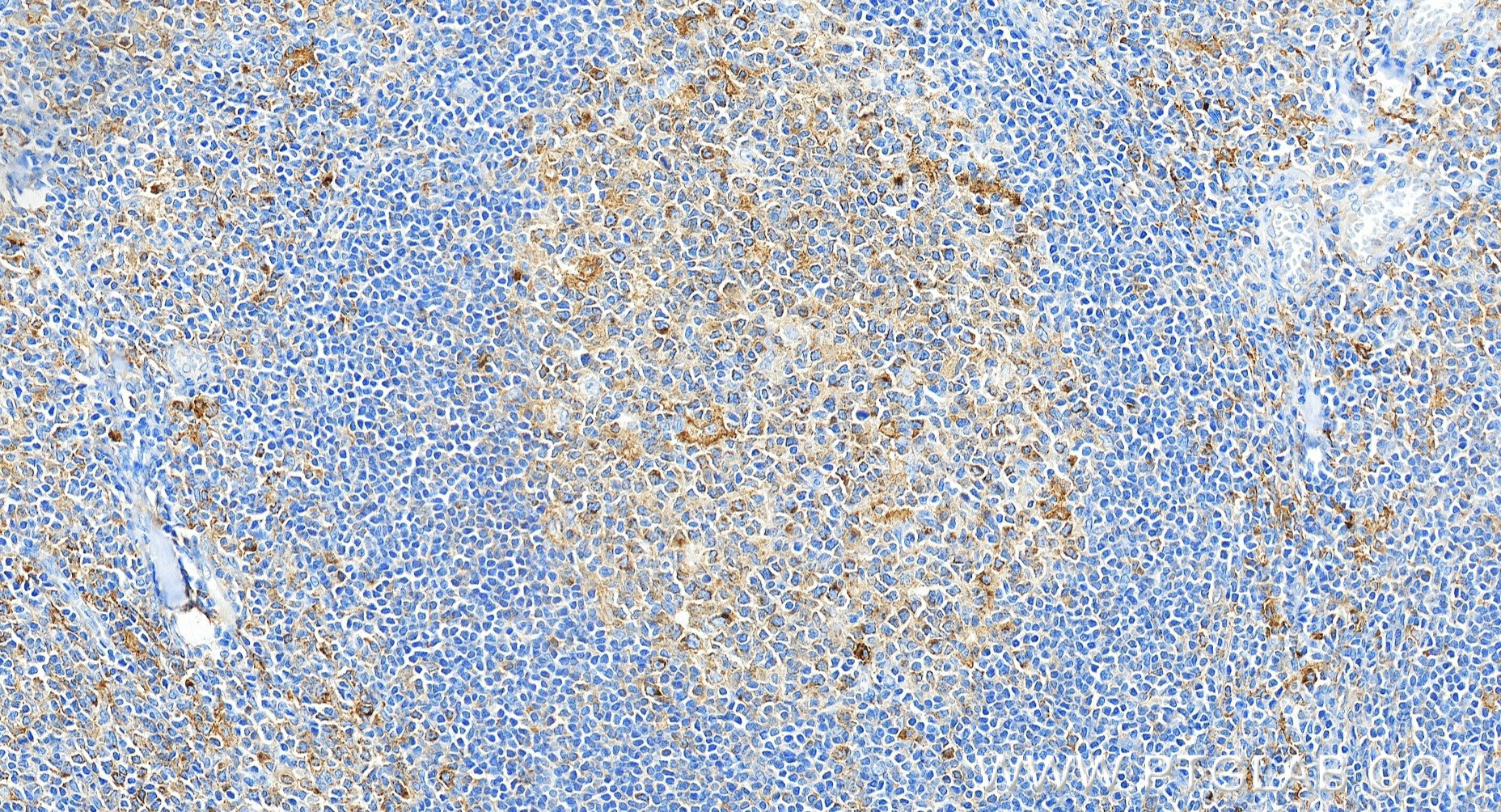 IHC staining of human tonsillitis using 81793-13-RR (same clone as 81793-13-PBS)