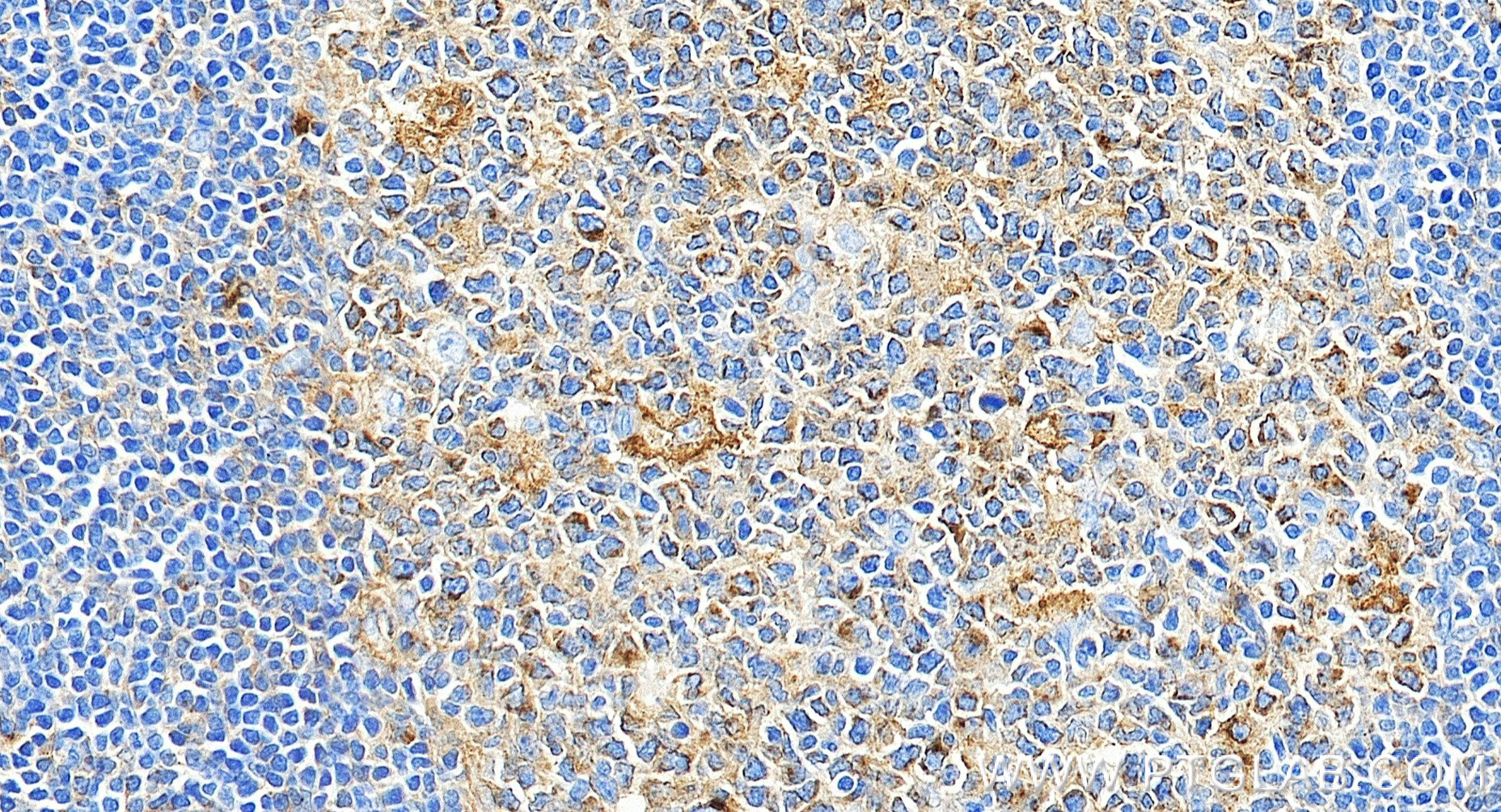 IHC staining of human tonsillitis using 81793-13-RR (same clone as 81793-13-PBS) IHC staining of human tonsillitis using 81793-13-RR (same clone as 81793-13-PBS)