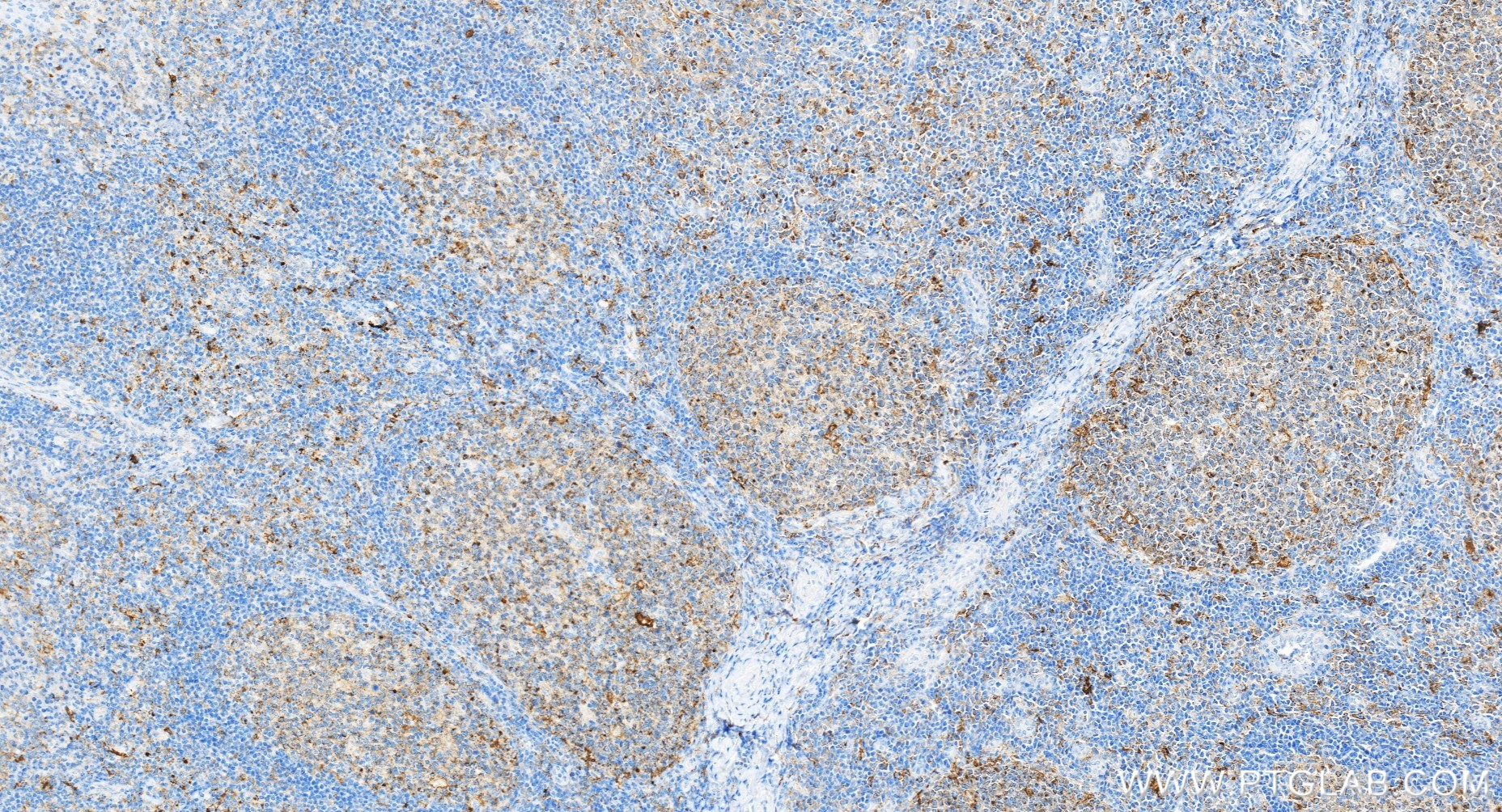 IHC staining of human tonsillitis using 81793-14-RR